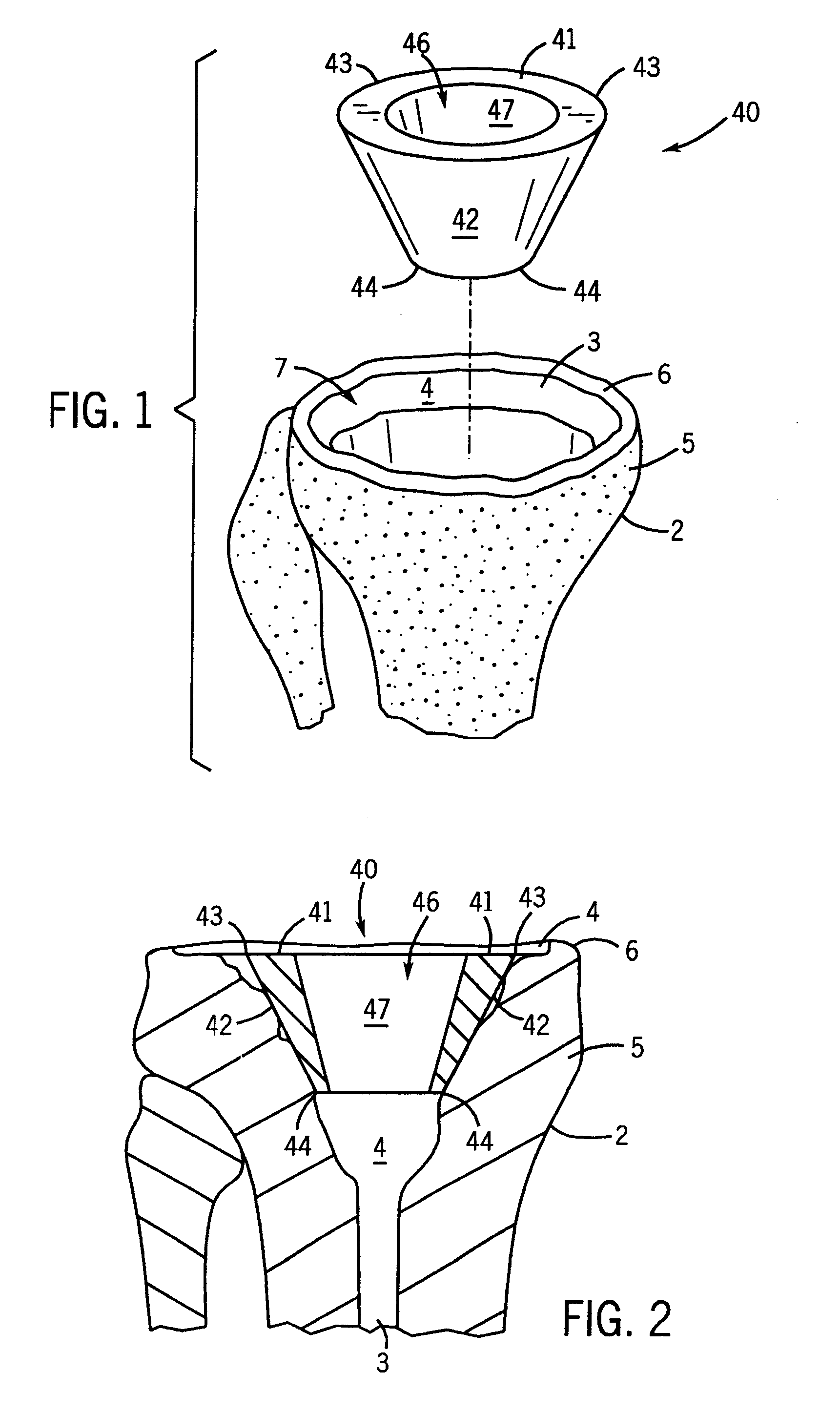 Prosthetic implant support structure