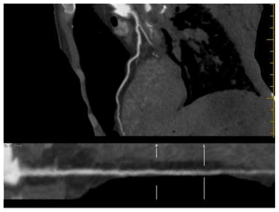 Device and method for corpse targeted cardiovascular and cerebrovascular radiography