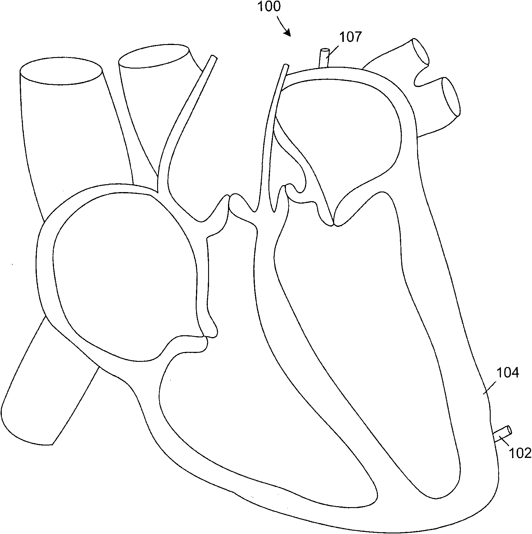 Leadless cardiac pacemaker and system