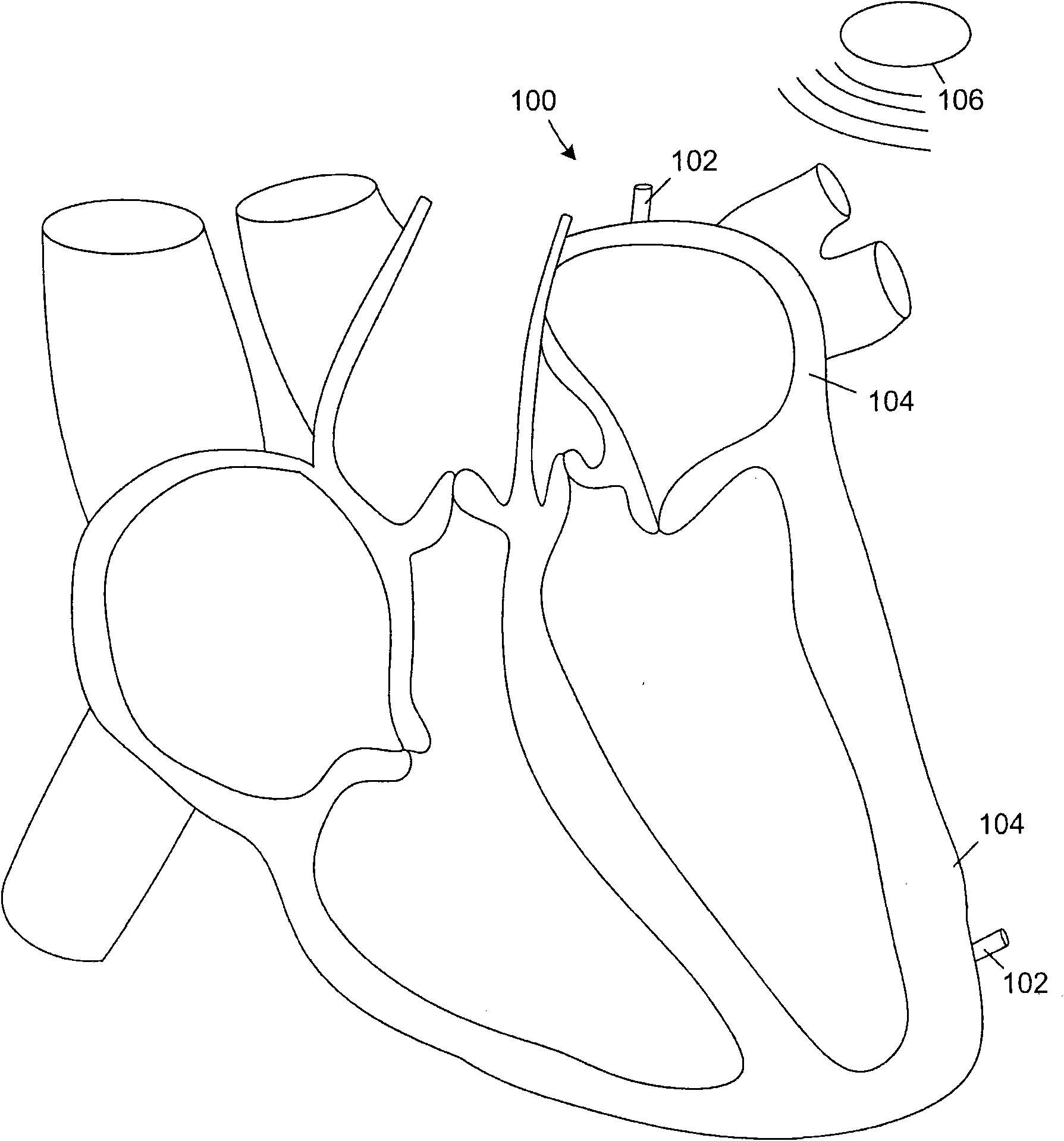 Leadless cardiac pacemaker and system