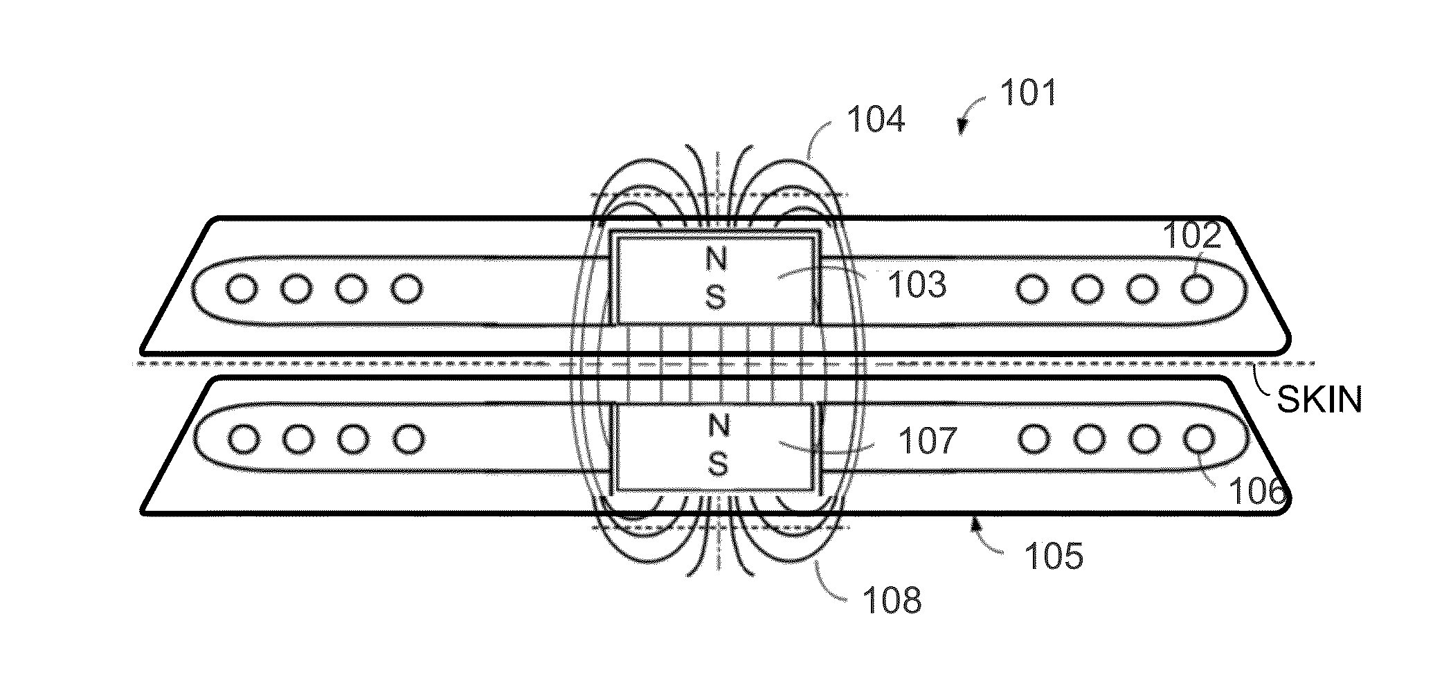 MRI-Safe Implant Magnet with Angular Magnetization