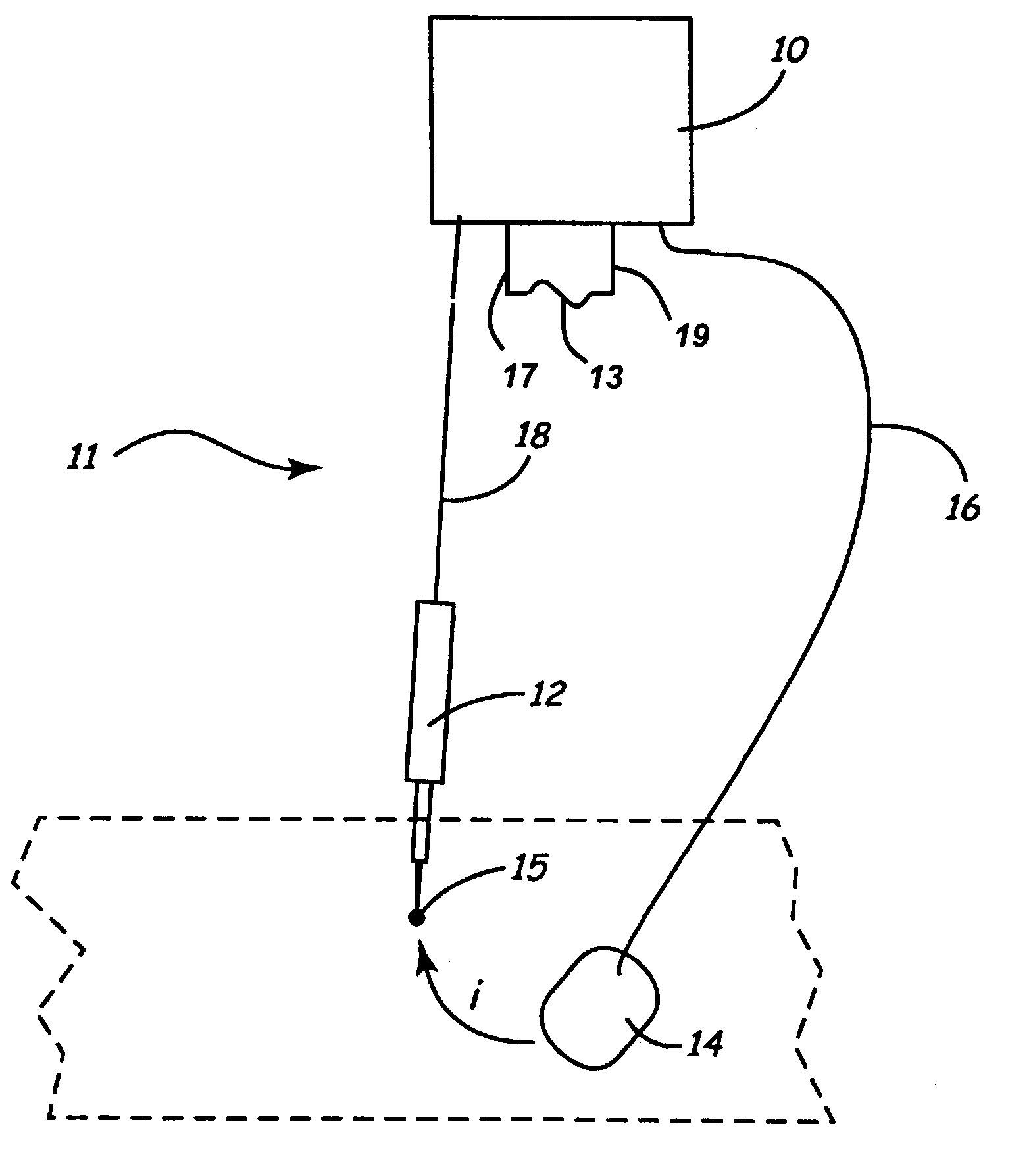 Lead set for nerve stimulator and method of operation thereof