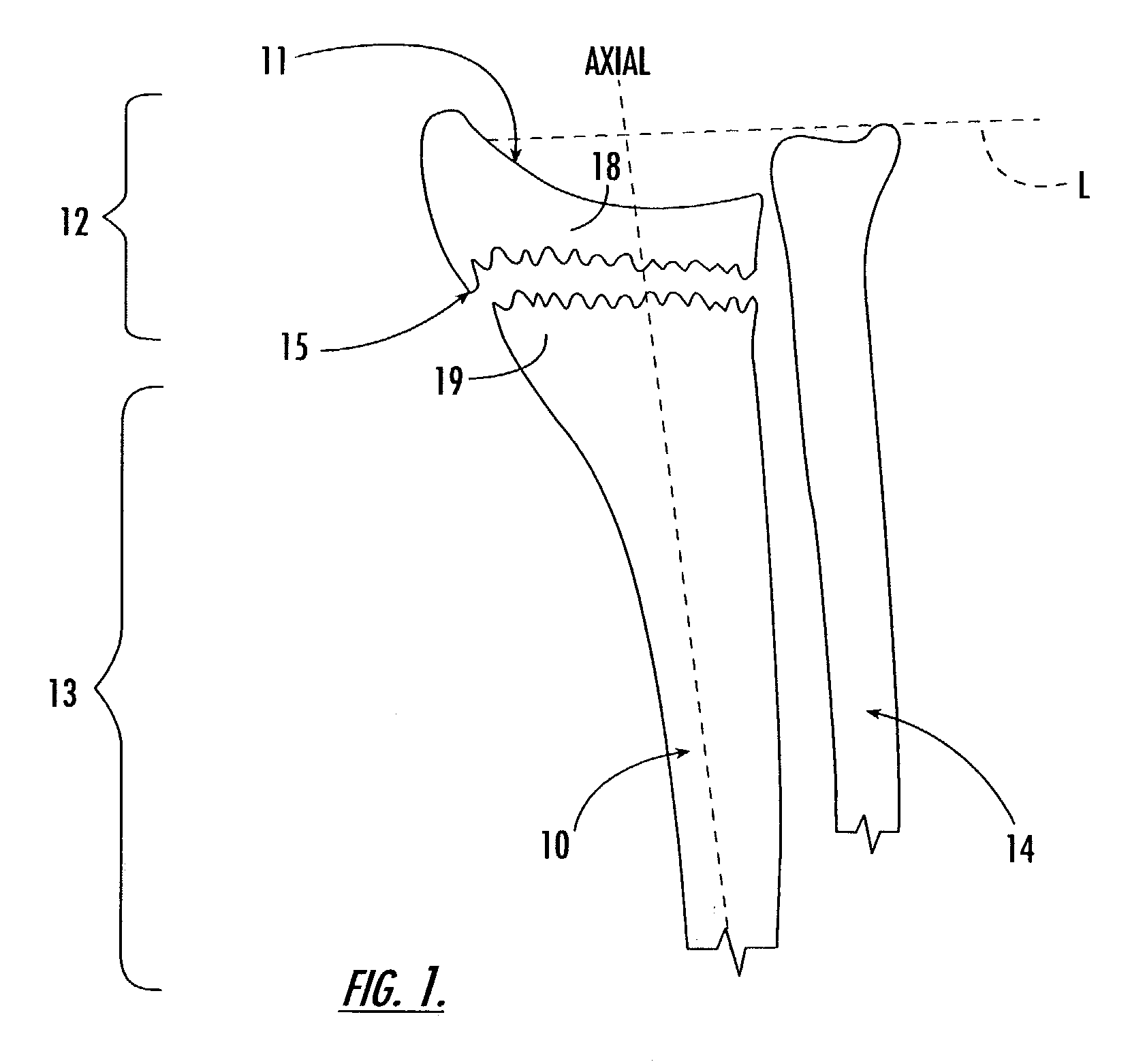 Intramedullary interlocking fixation device for the distal radius