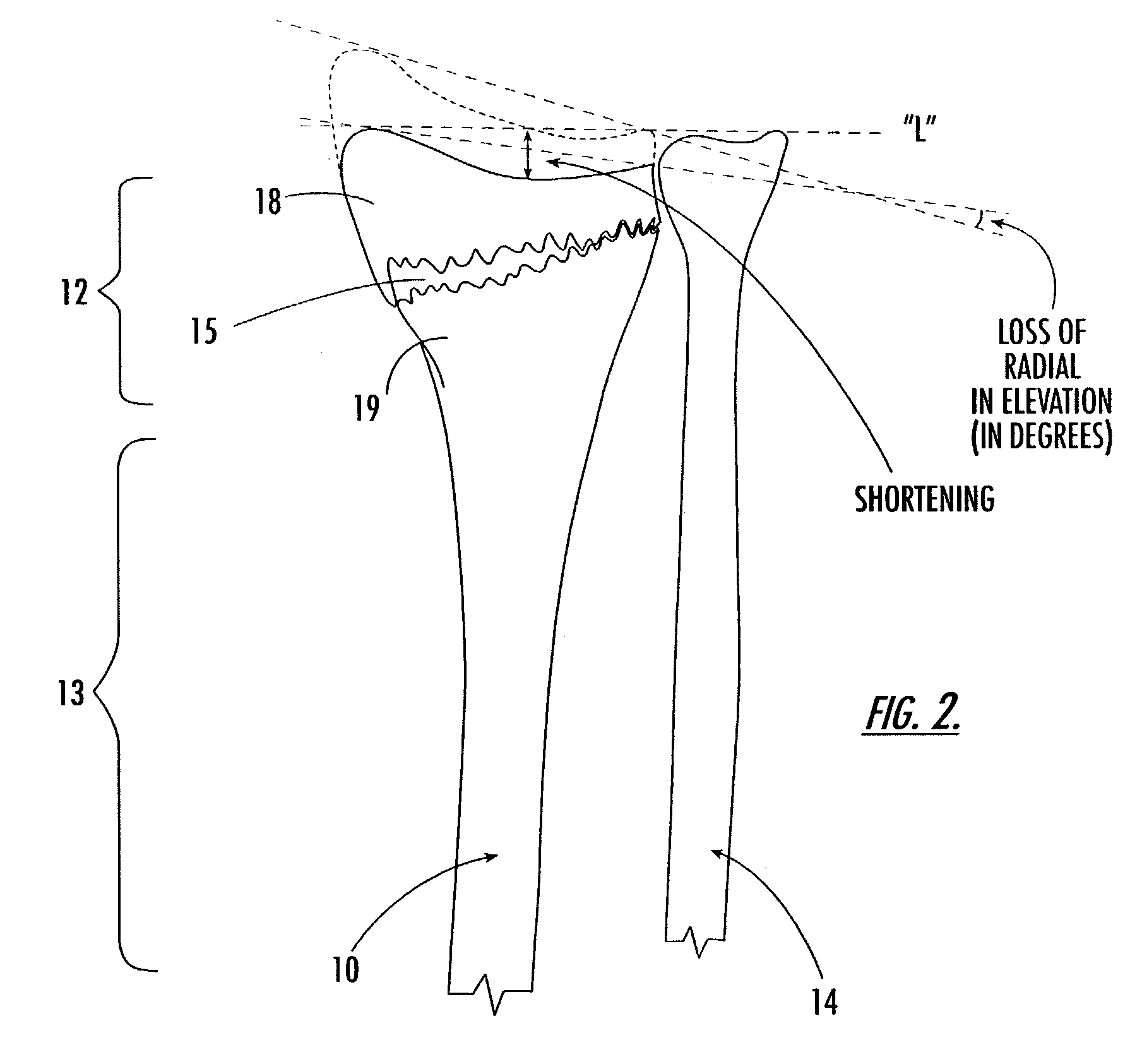 Intramedullary interlocking fixation device for the distal radius