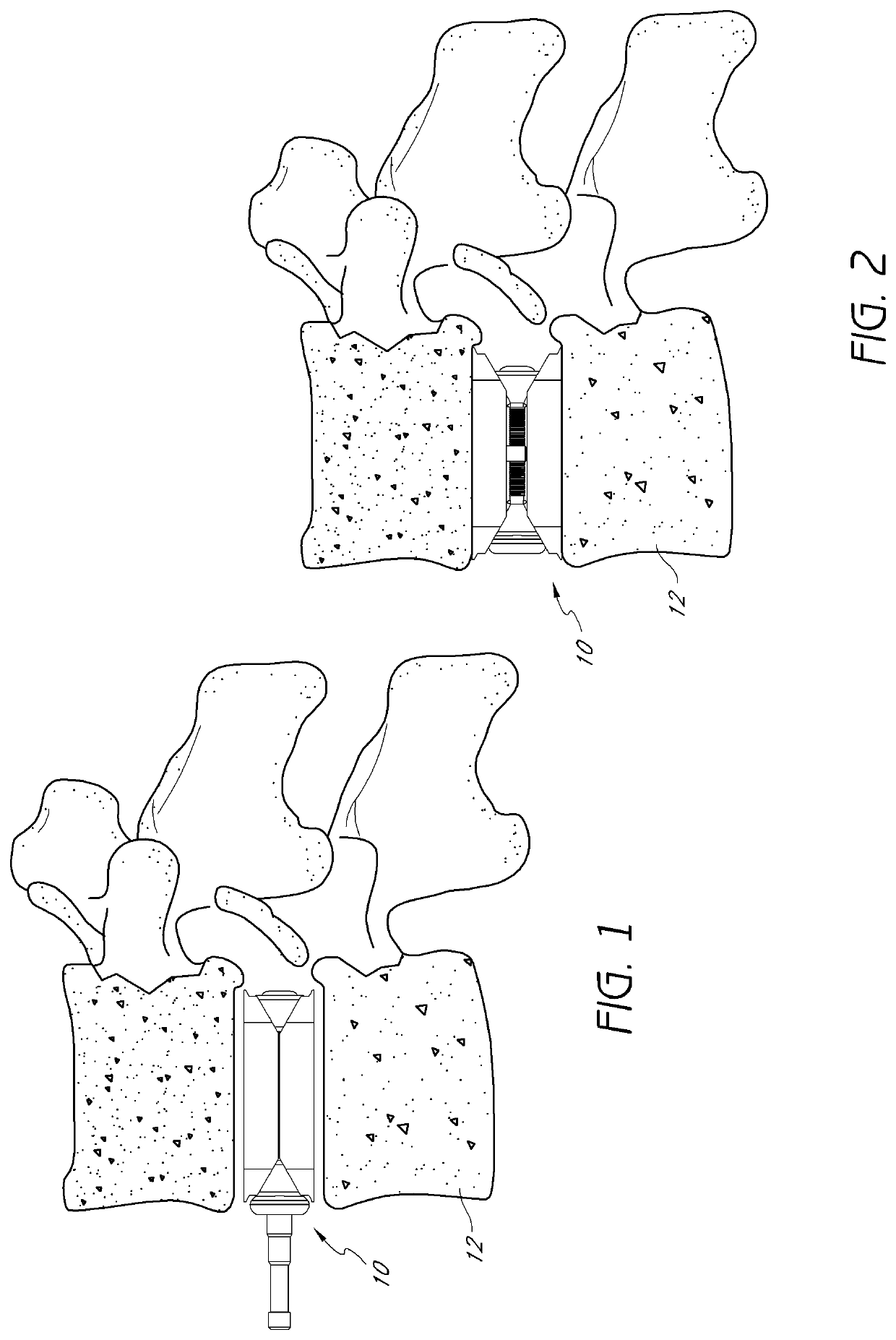 Intervertebral implant and bone graft inserter