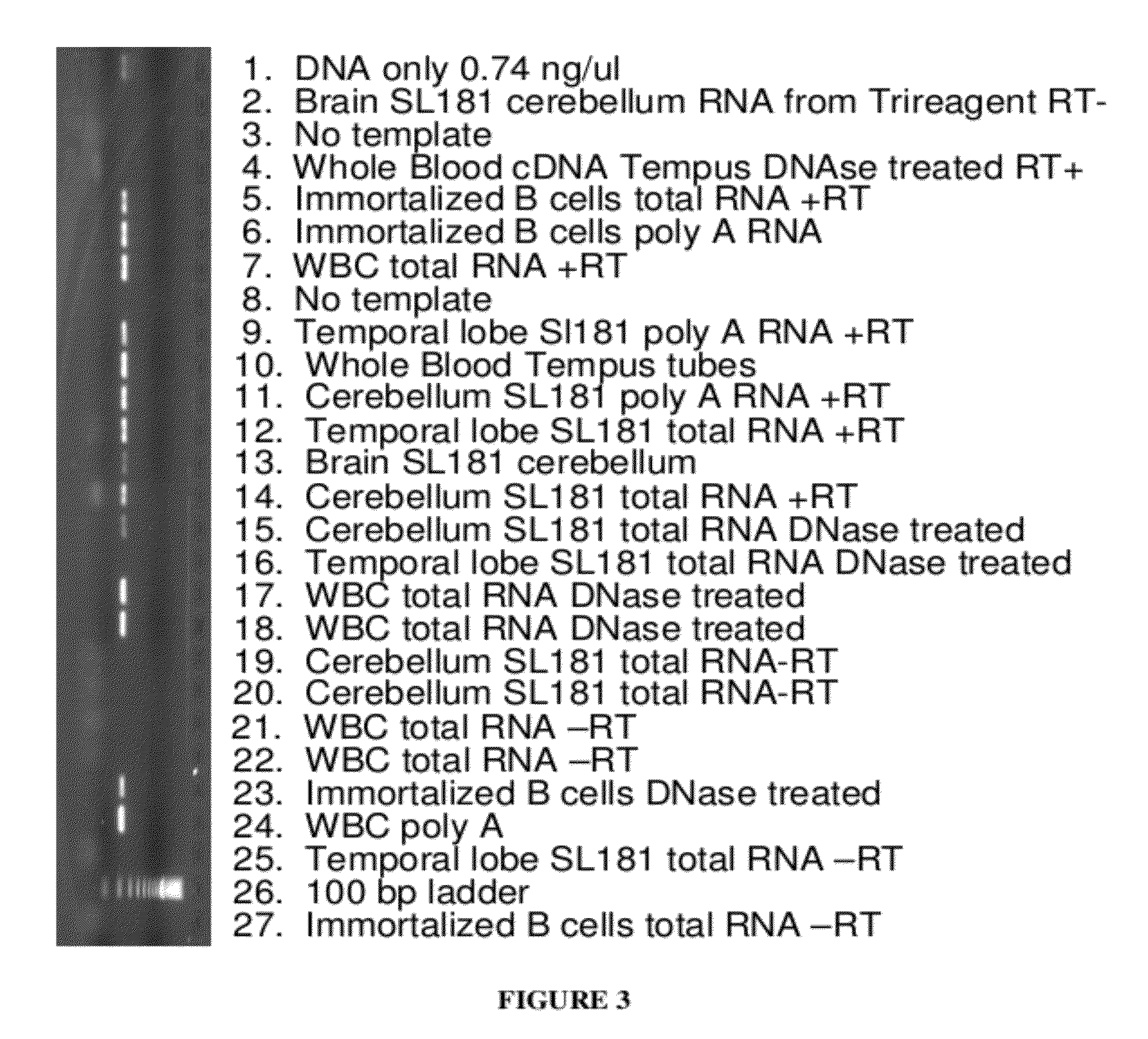 Schizophrenia treatment response biomarkers