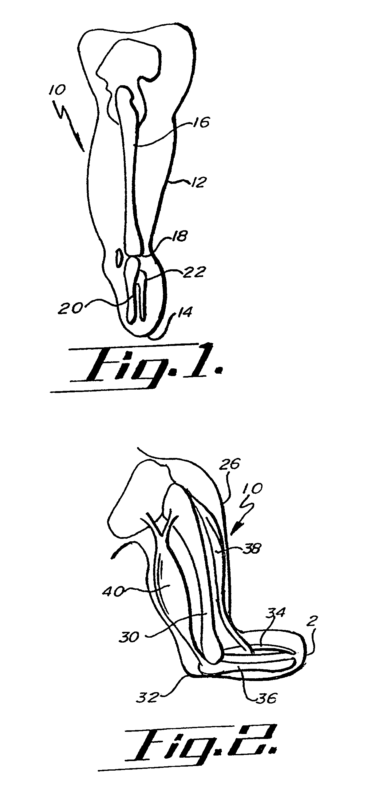 Osmotic membrane and vacuum system for artificial limb