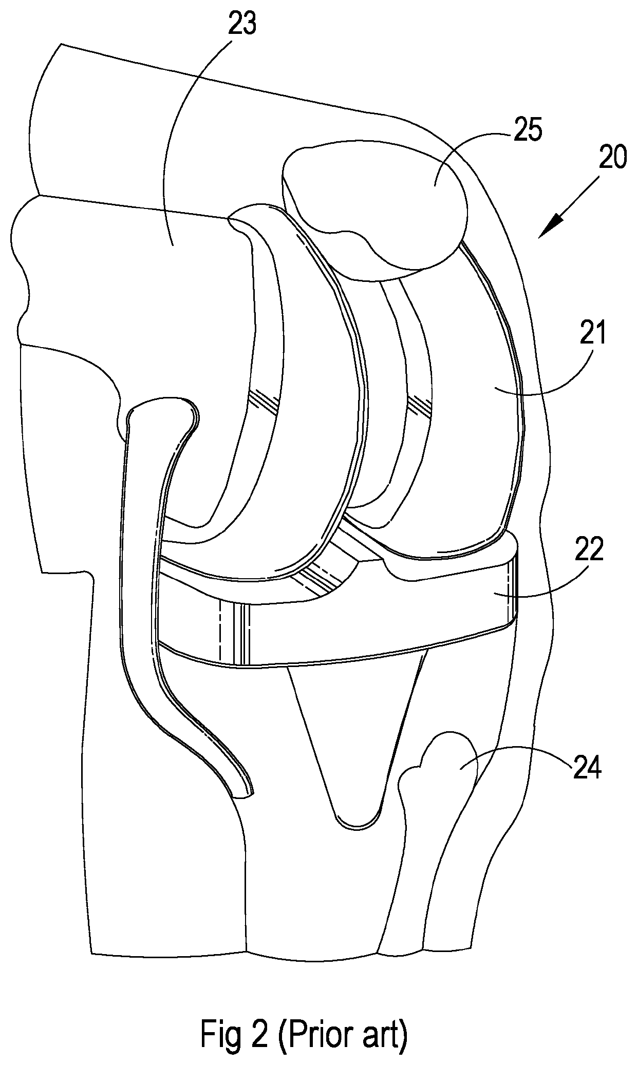 Implantable electronic device and endoprosthesis