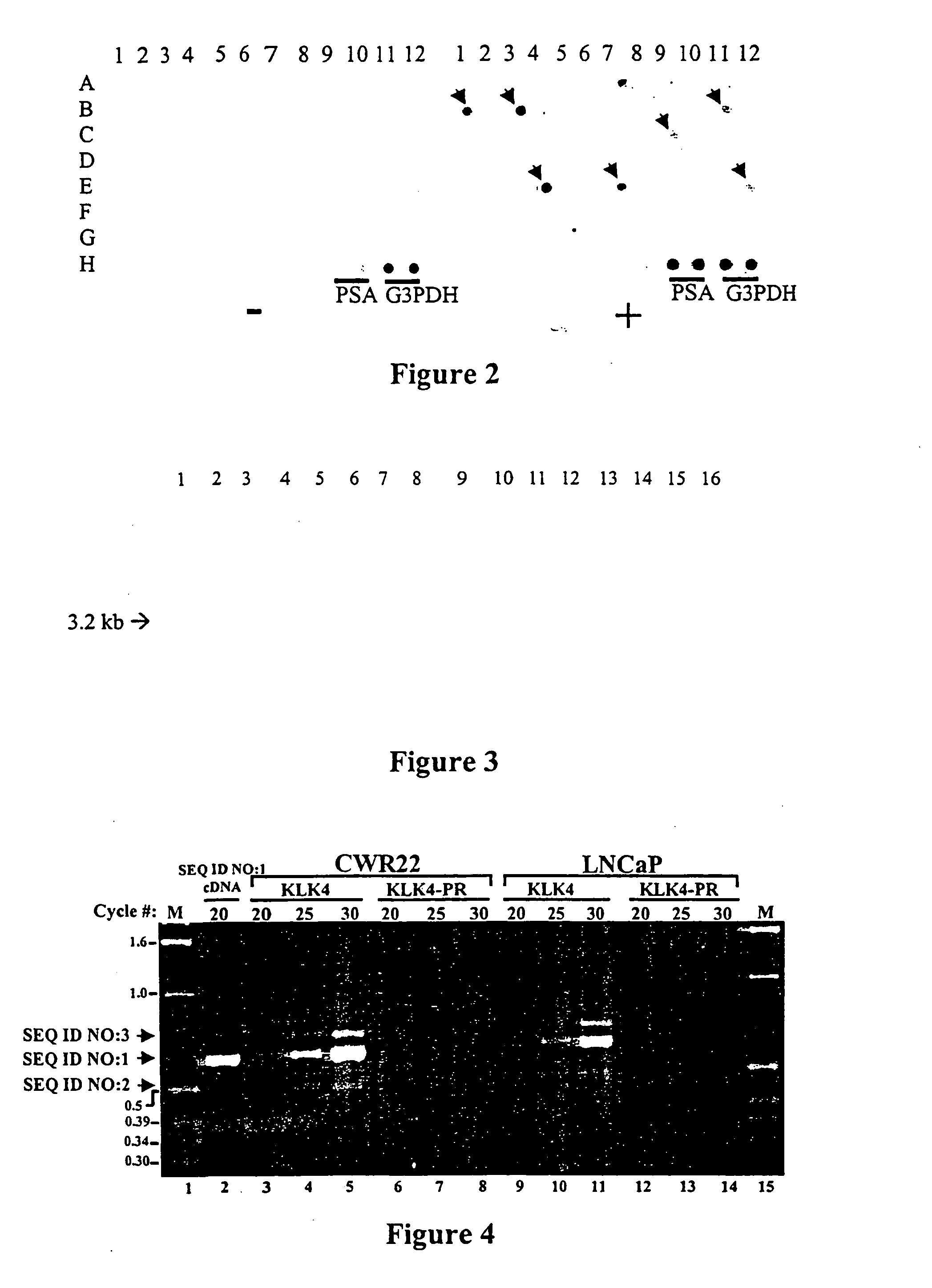 Differentially expressed genes in prostate cancer