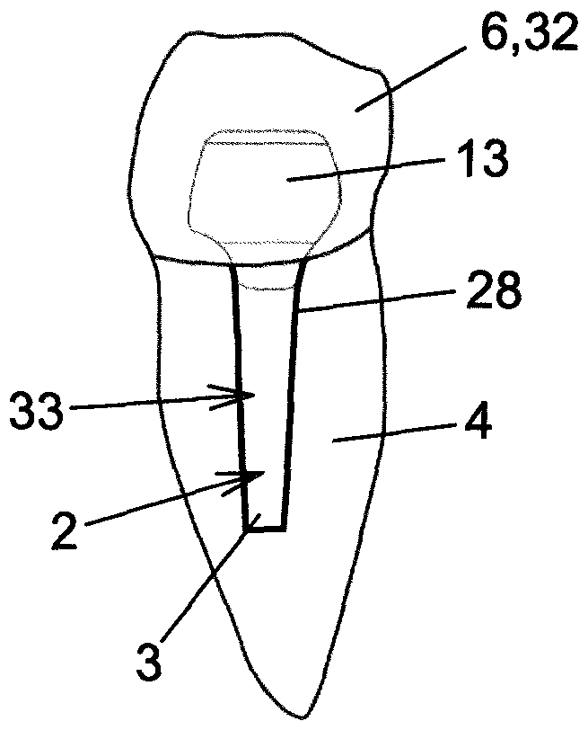 endodontic pin