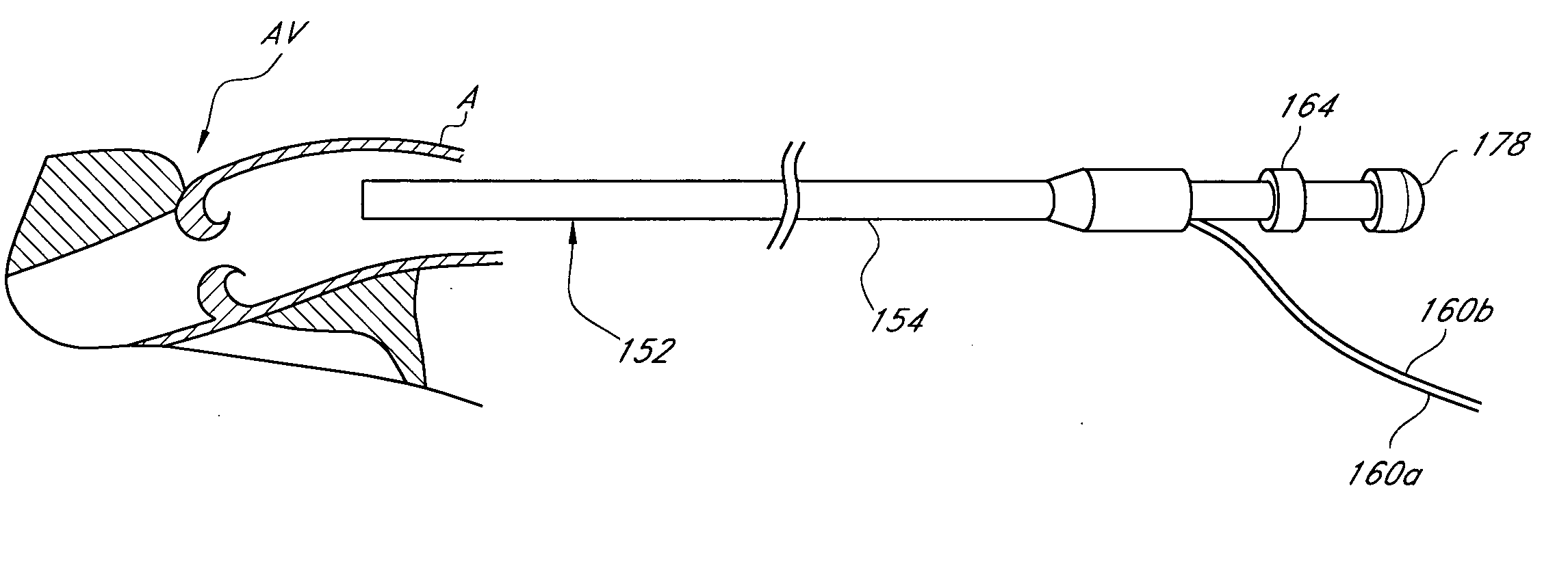 Catheter-based tissue remodeling devices and methods