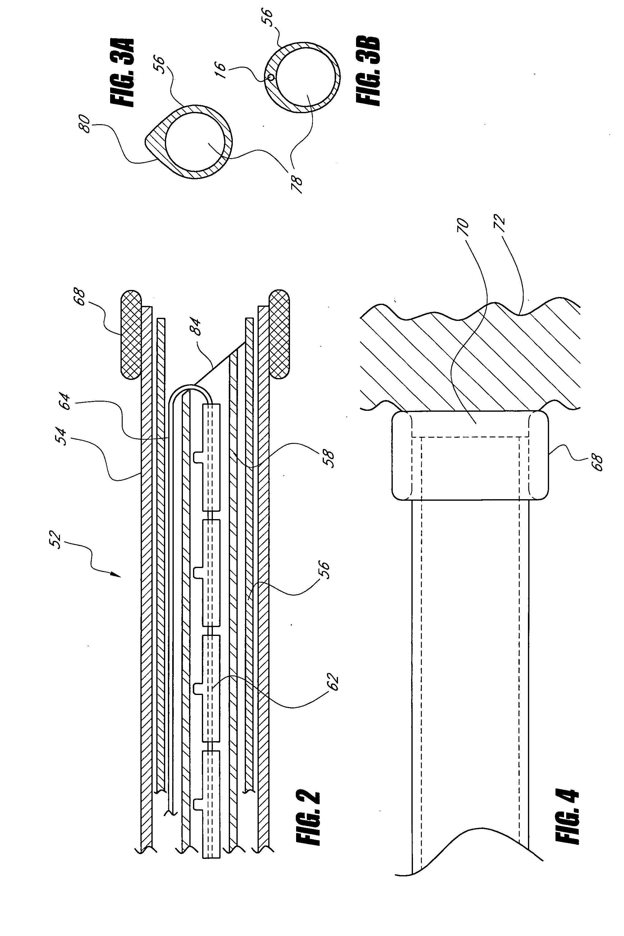 Catheter-based tissue remodeling devices and methods