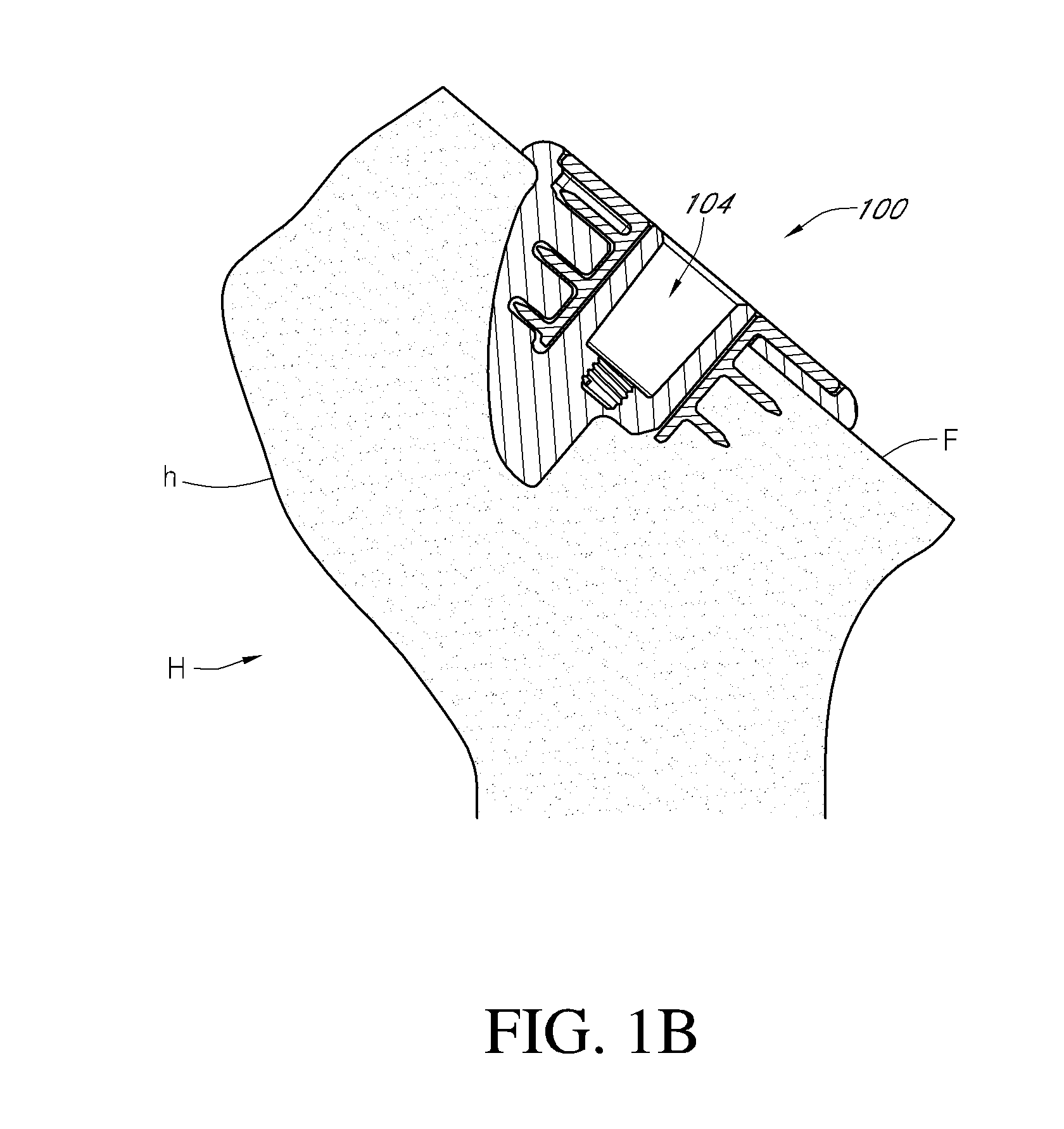 Humeral implant anchor system