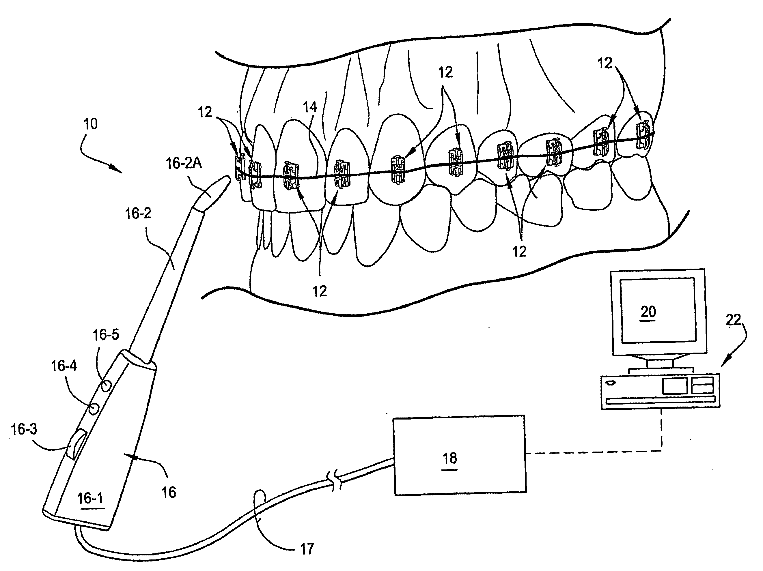 Method and System for Determining a Force and/or Torque Applied to an Orthodontic Bracket