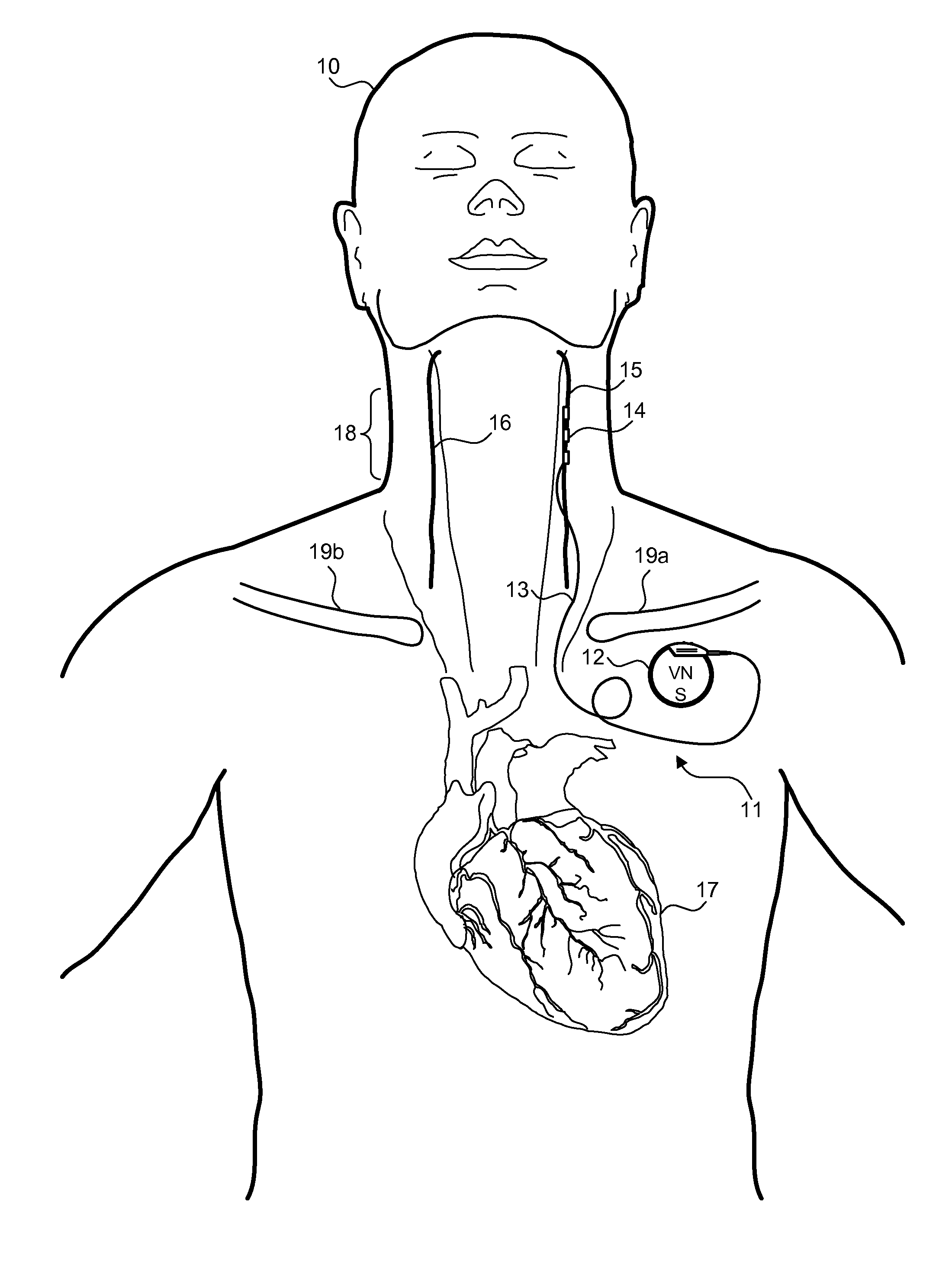 Implantable device for evaluating autonomic cardiovascular drive in a patient suffering from chronic cardiac dysfunction