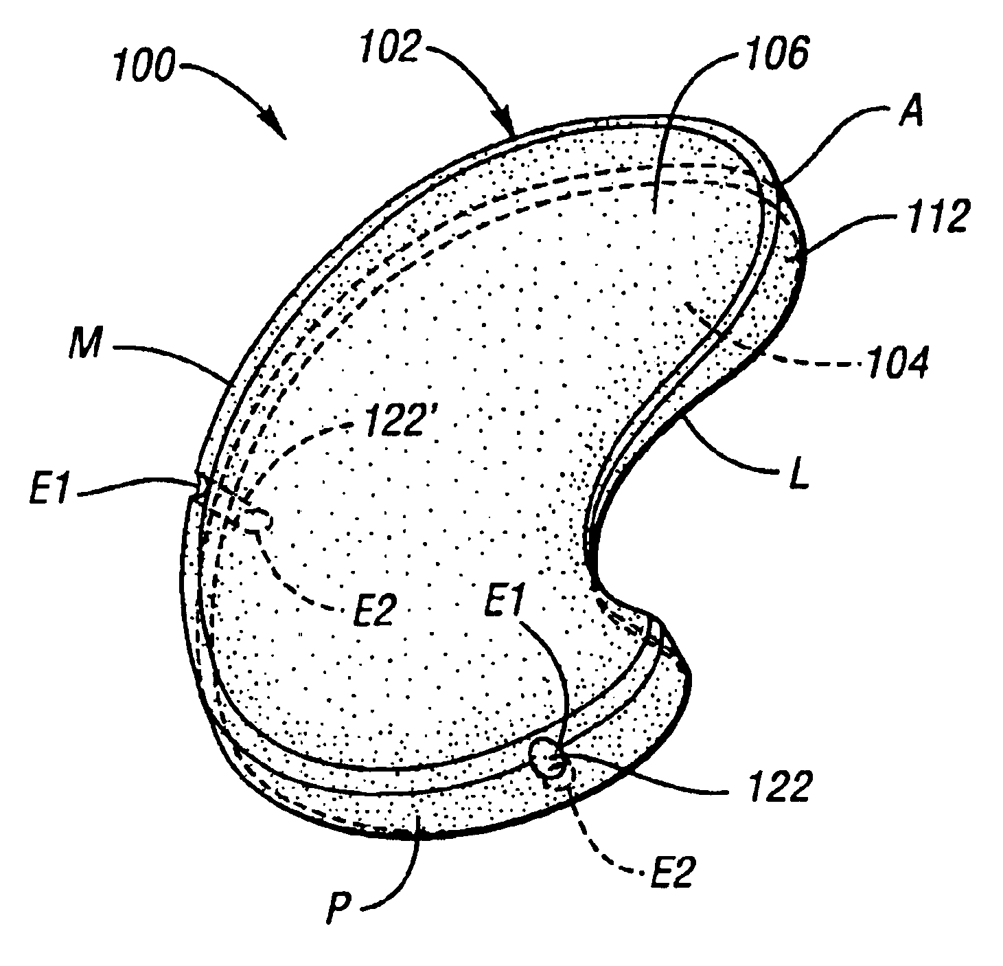 Surgically implantable knee prosthesis having attachment apertures