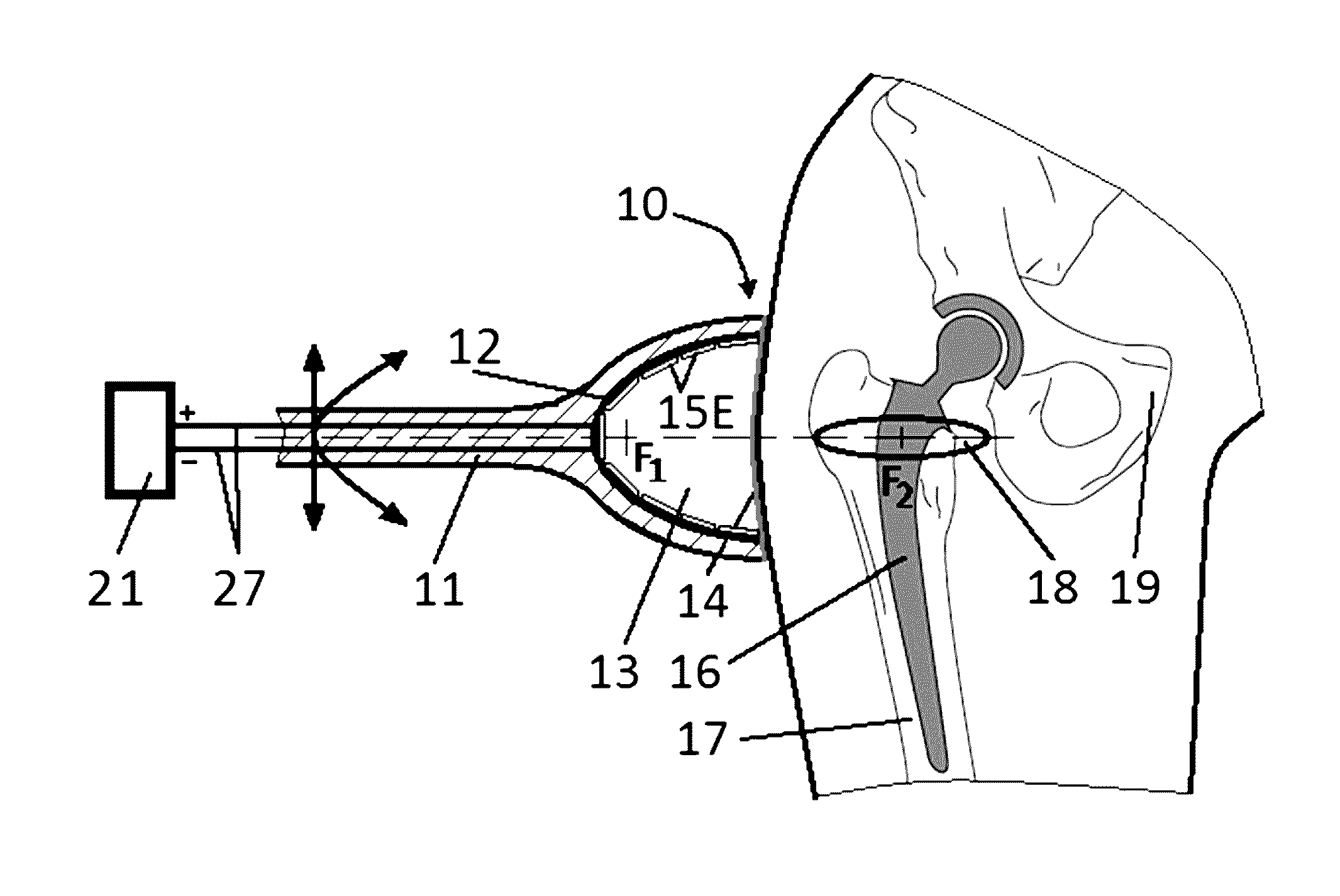 Tissue Disinfection with Acoustic Pressure Shock Waves