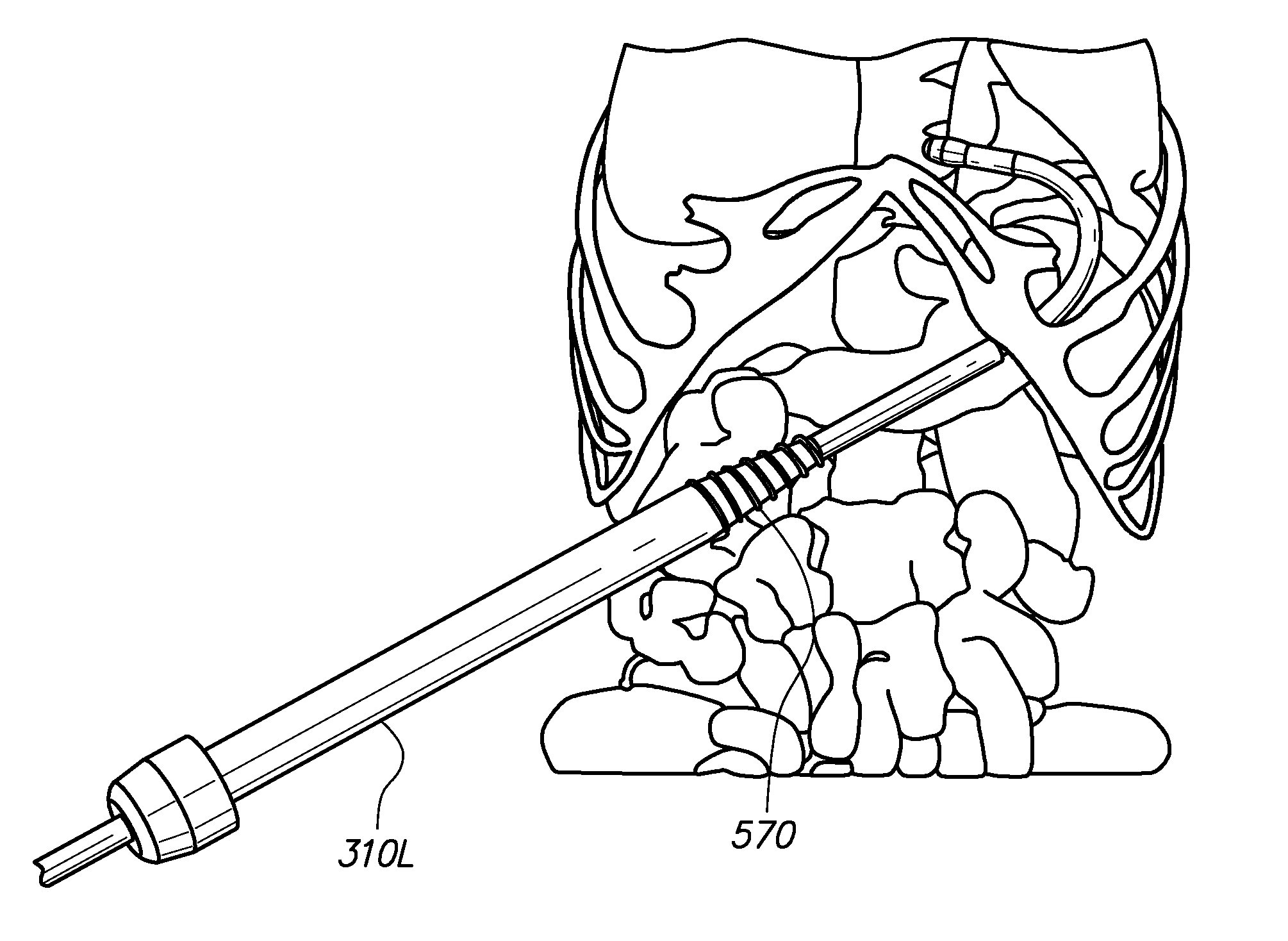 Devices, tools and methods for performing minimally invasive abdominal surgical procedures