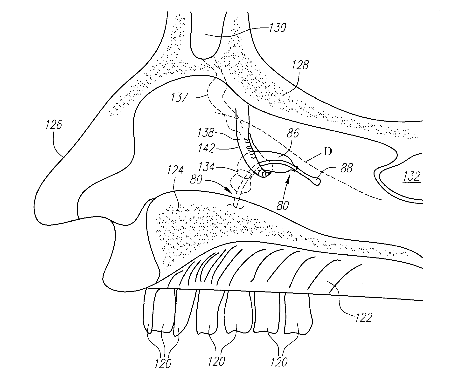 Apparatus and method for treatment of sinusitis