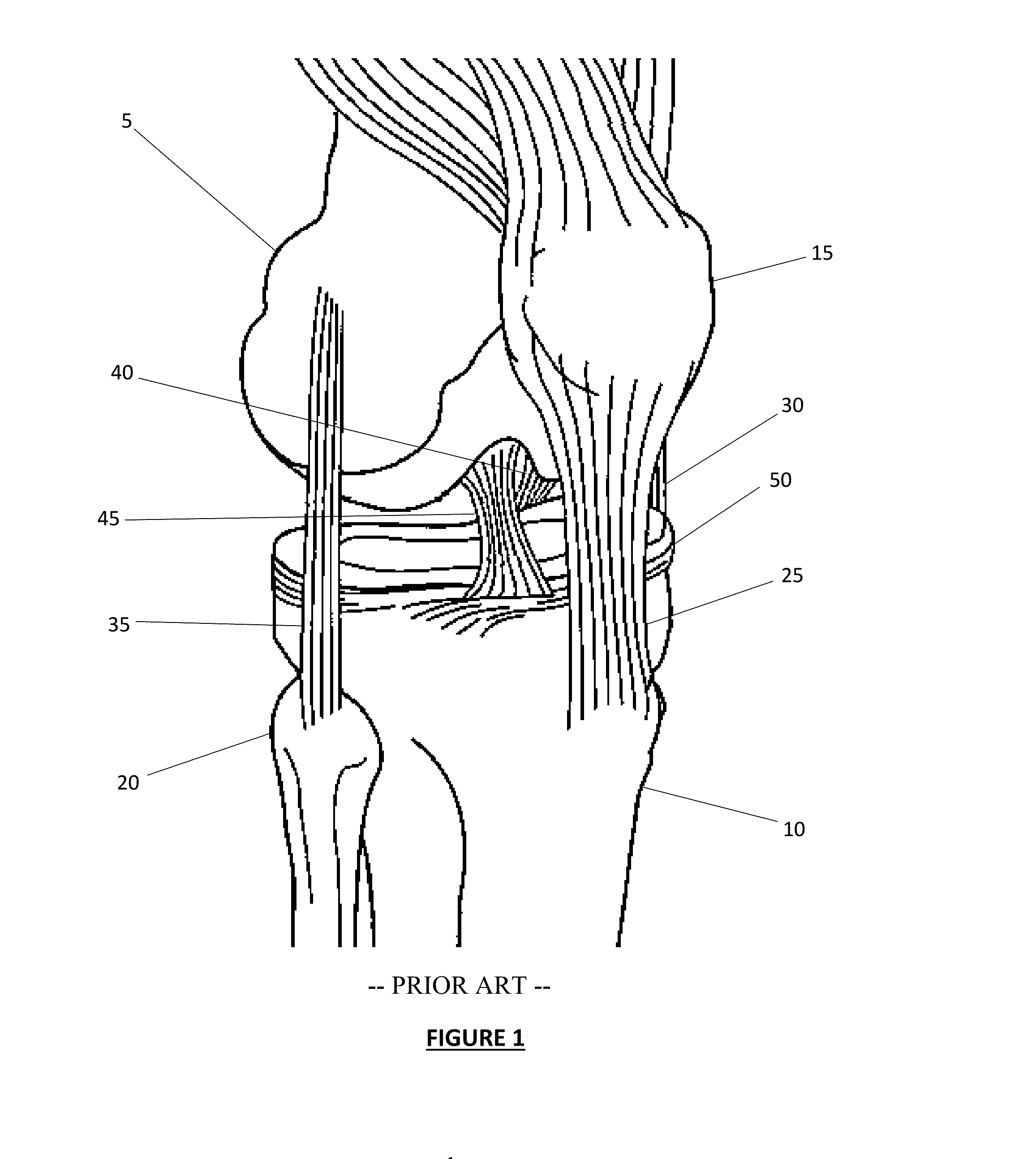 Total Knee Arthroplasty System and Method