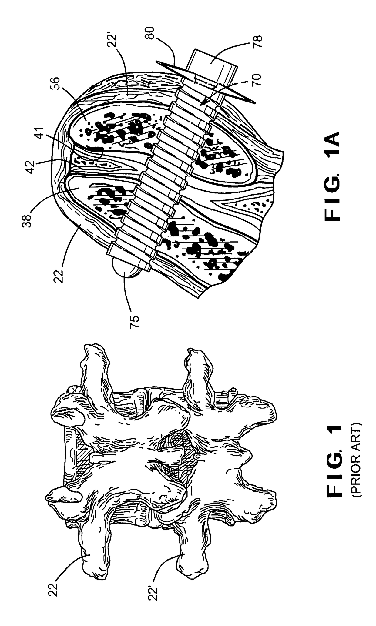 Bioactive fusion device