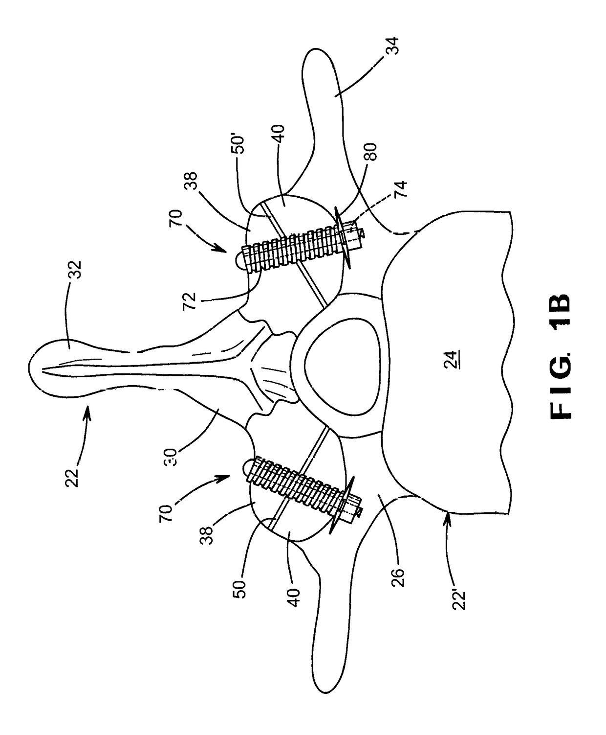 Bioactive fusion device