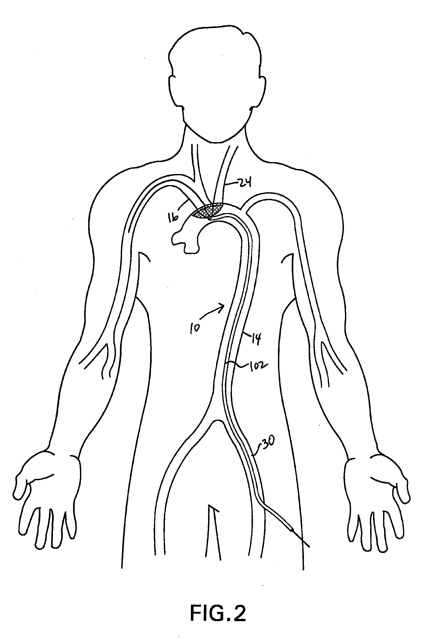 Methods of deploying and retrieving an embolic diversion device