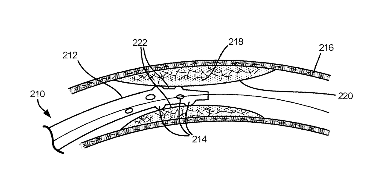 Catheter for Advancing Through a Vascular Stenosis and Related Methods