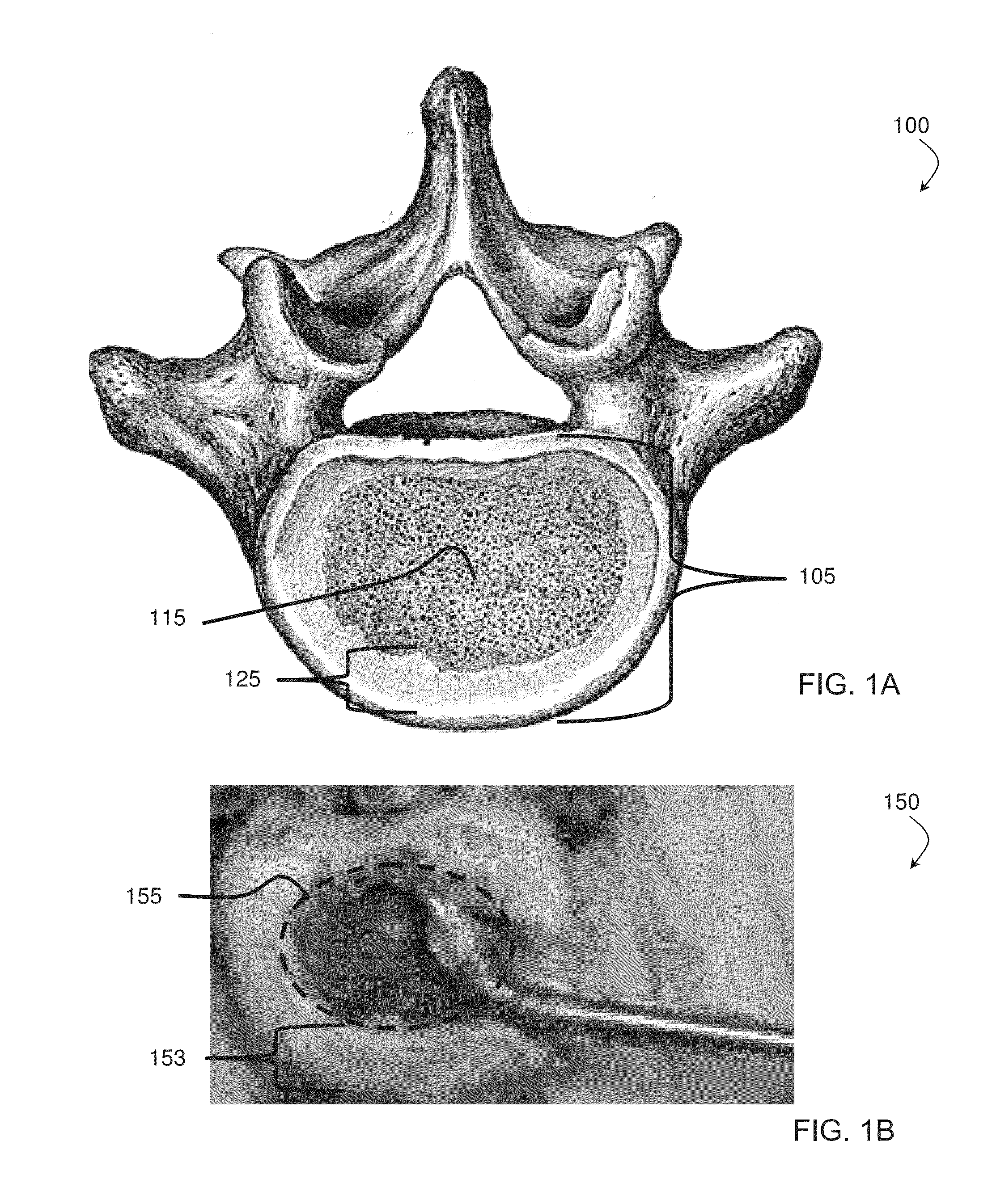 Method of distracting an intervertebral space