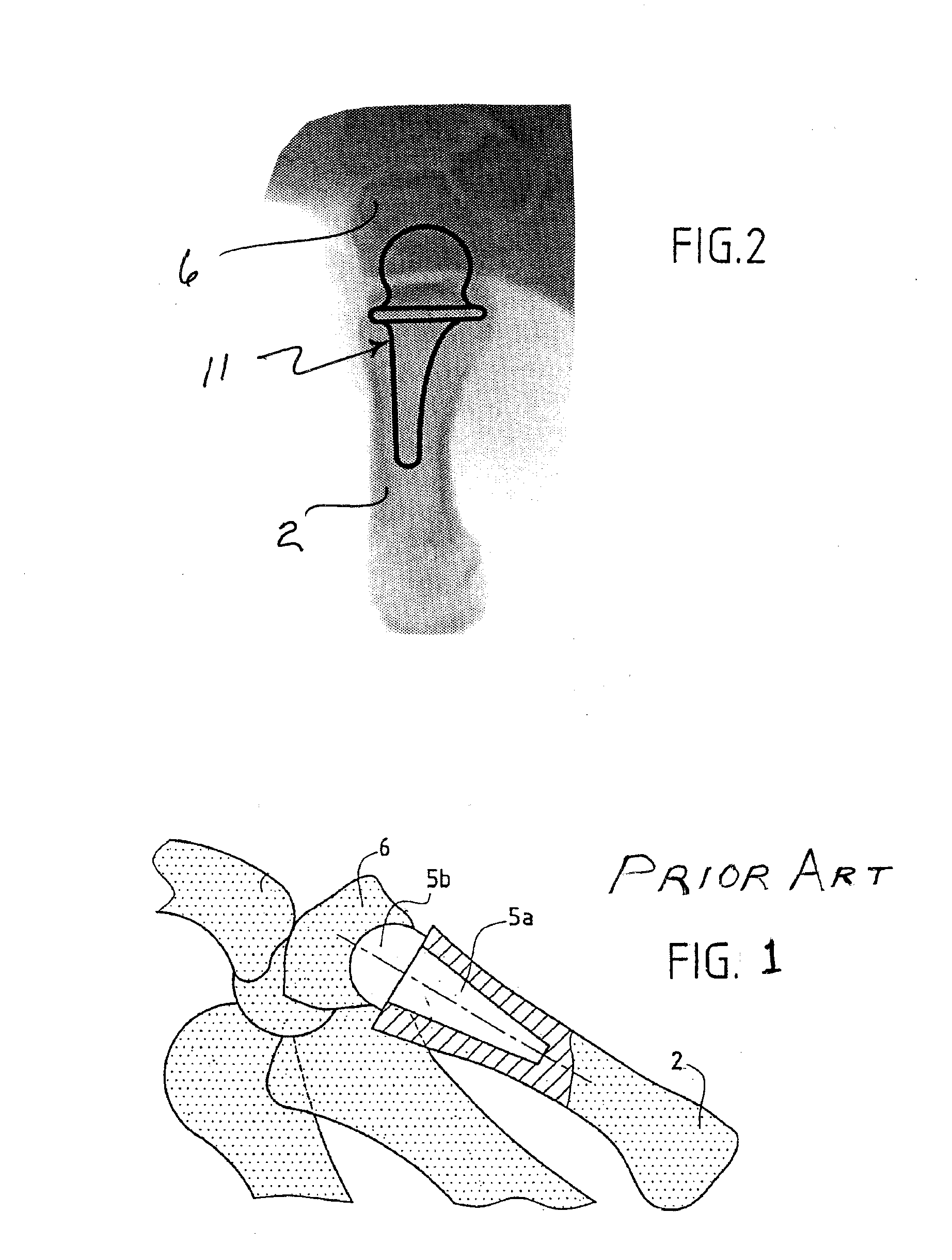 Thumb metacarpal implant