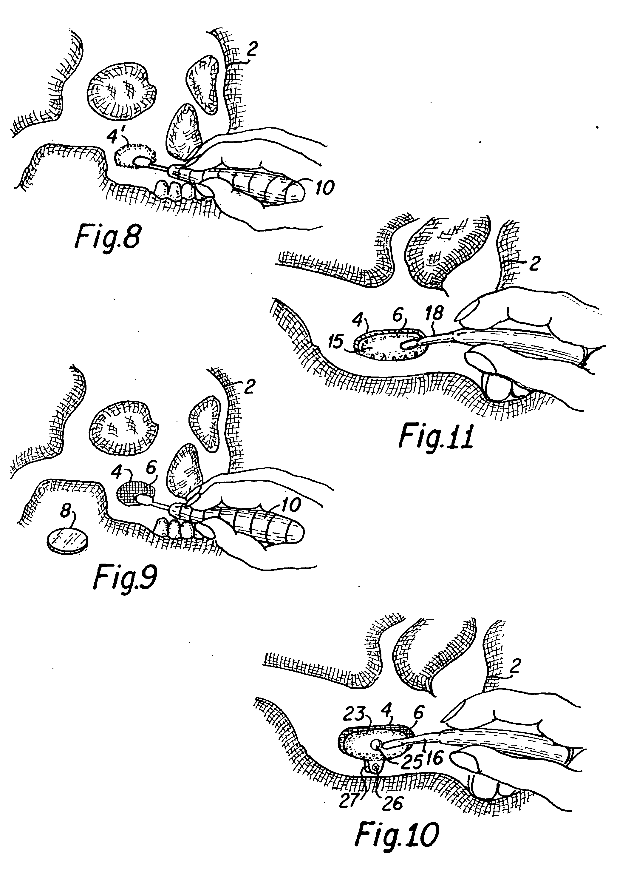 Maxillary sinus bone augmentation with resorbable bone pack