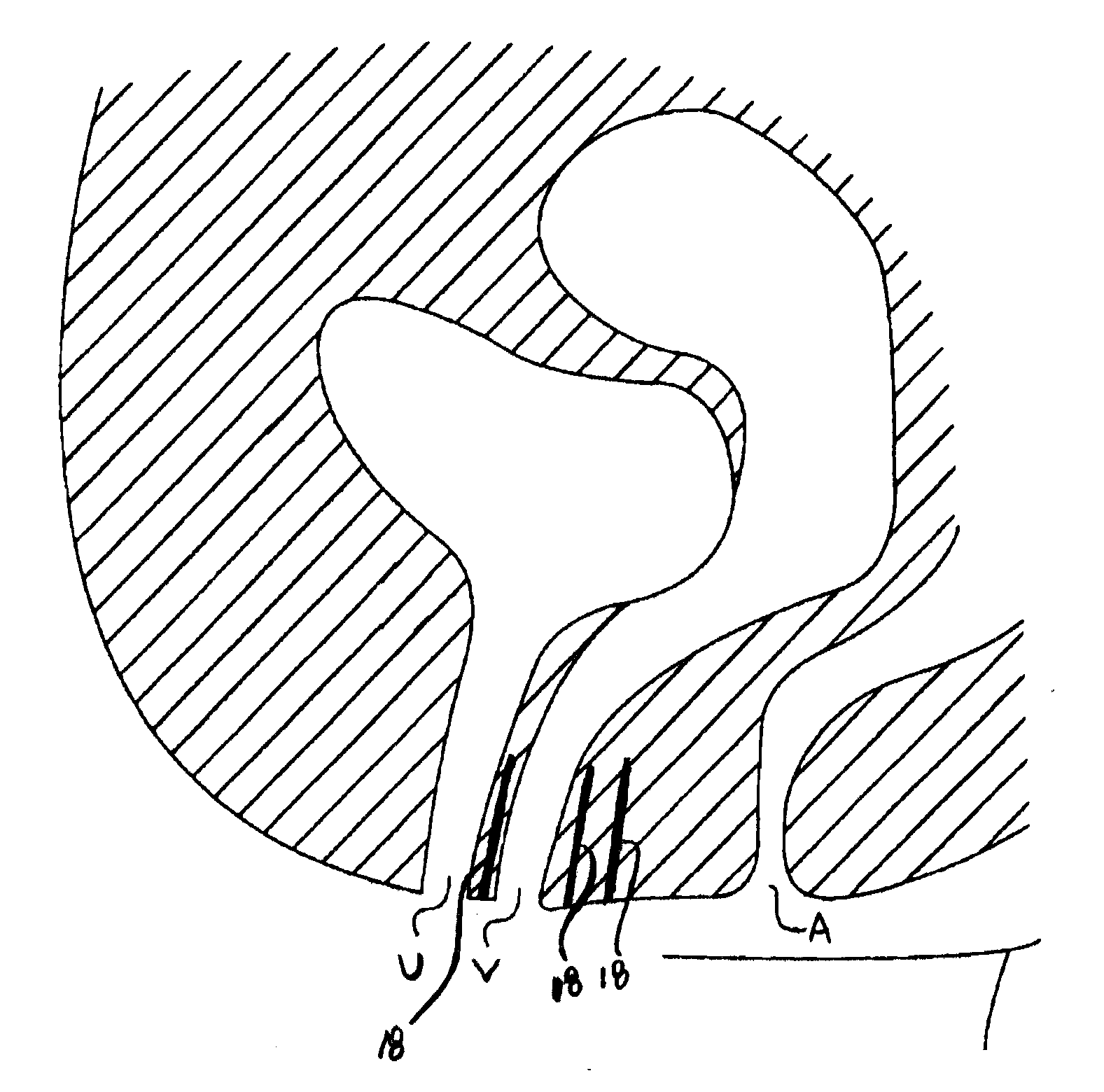 Elongate Implant System and Method for Treating Pelvic Conditions