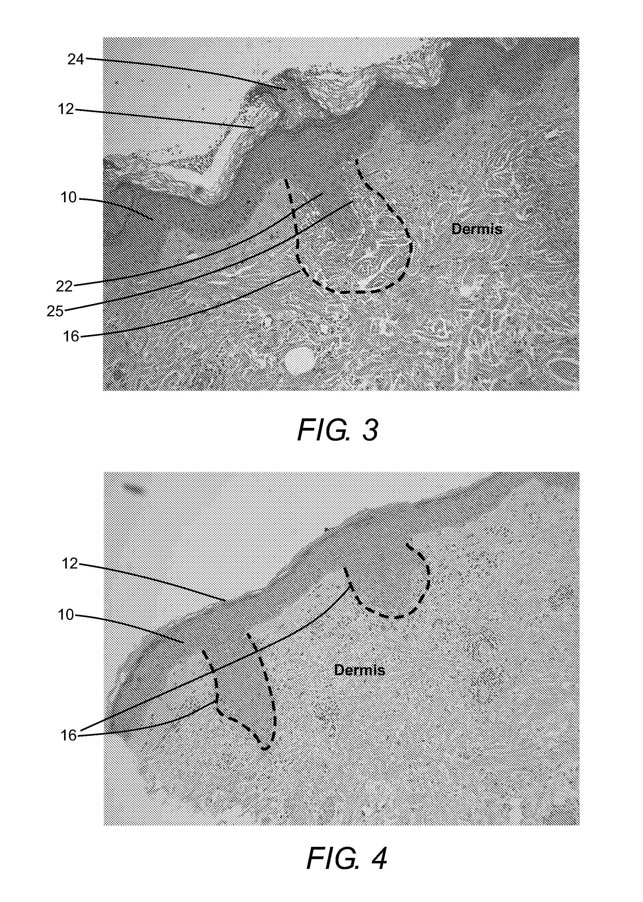 Micropore delivery of active substances