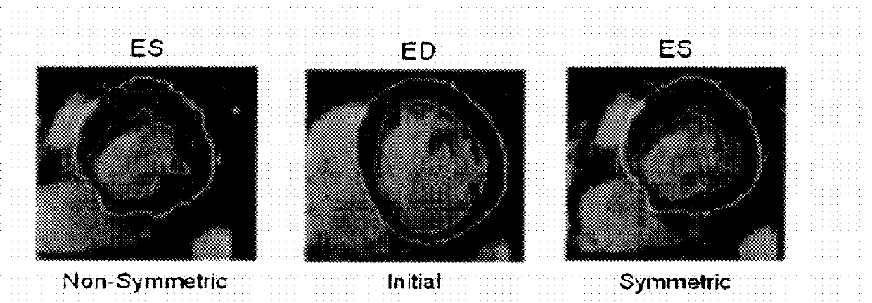 Symmetric and Inverse-Consistent Deformable Registration