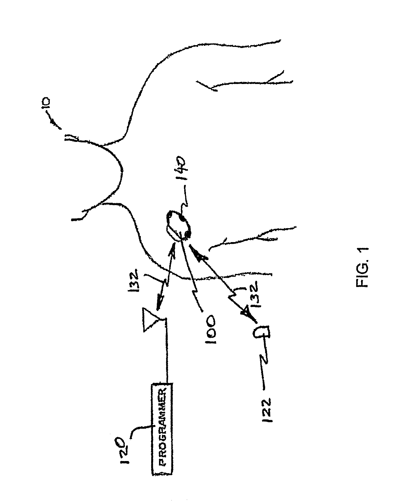 Peak data retention of signal data in an implantable medical device