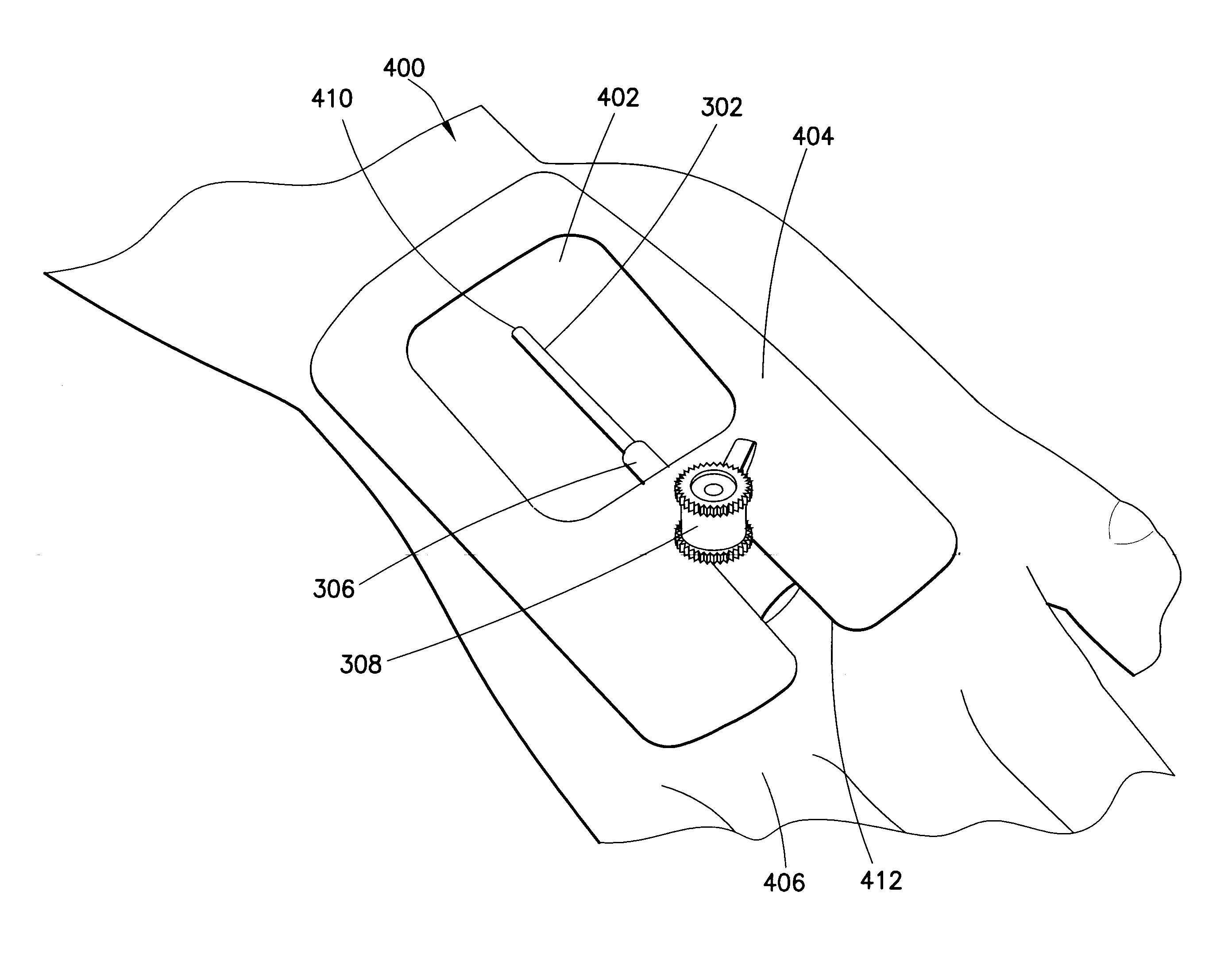 Methods and apparatus for reducing count of infectious agents in intravenous access system