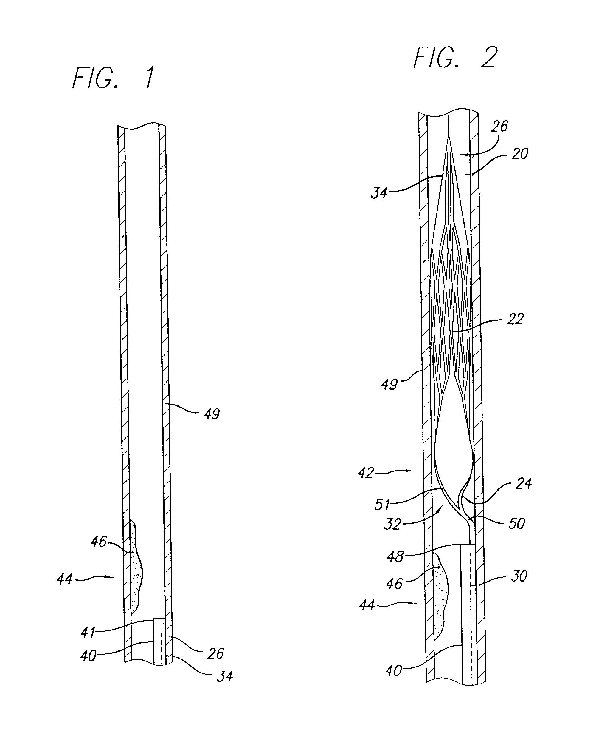 Embolic basket