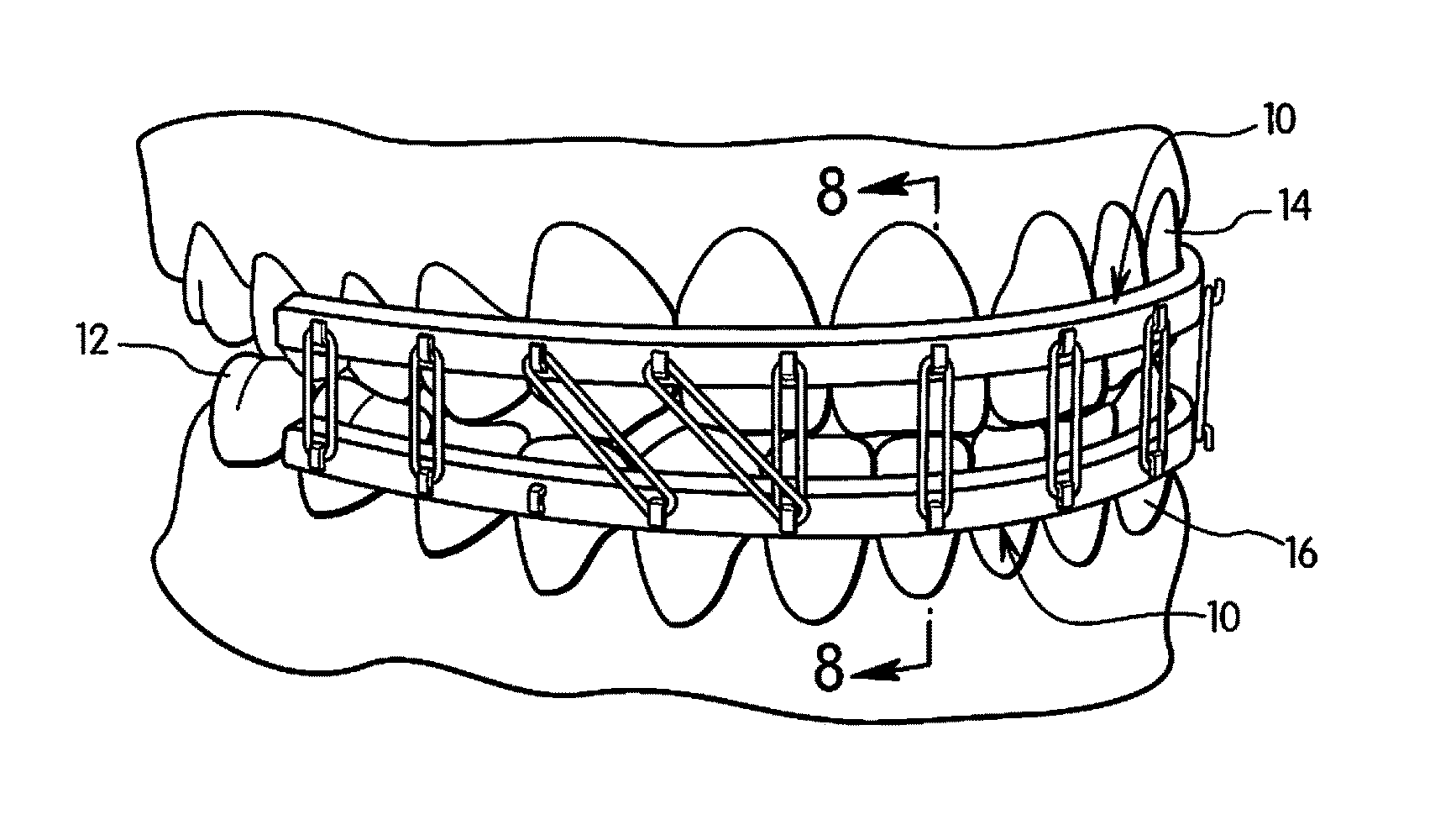 Singer-Domanski resin MMF/reimplantation device