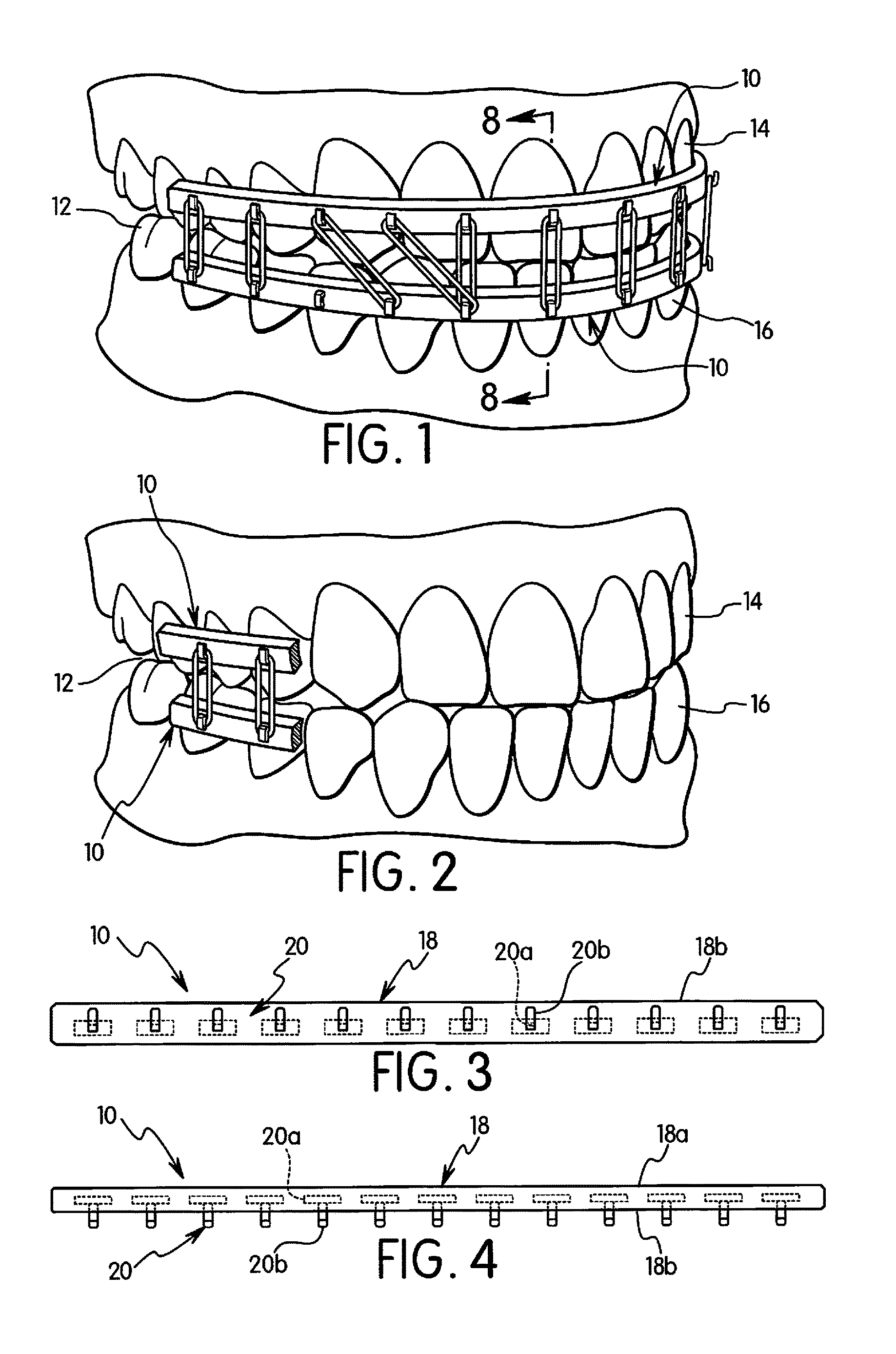 Singer-Domanski resin MMF/reimplantation device