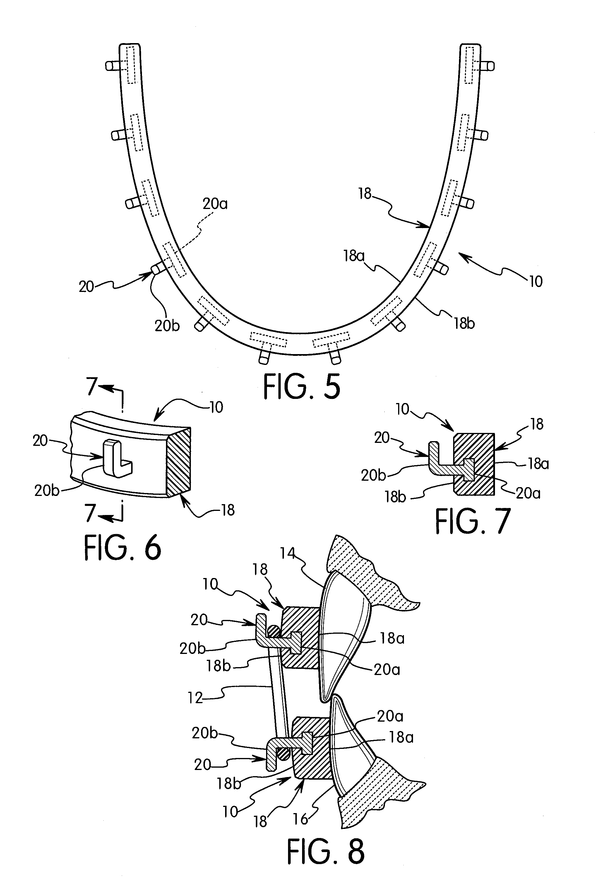 Singer-Domanski resin MMF/reimplantation device