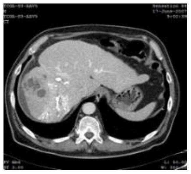 Liver CT image tumor segmentation method based on information fusion