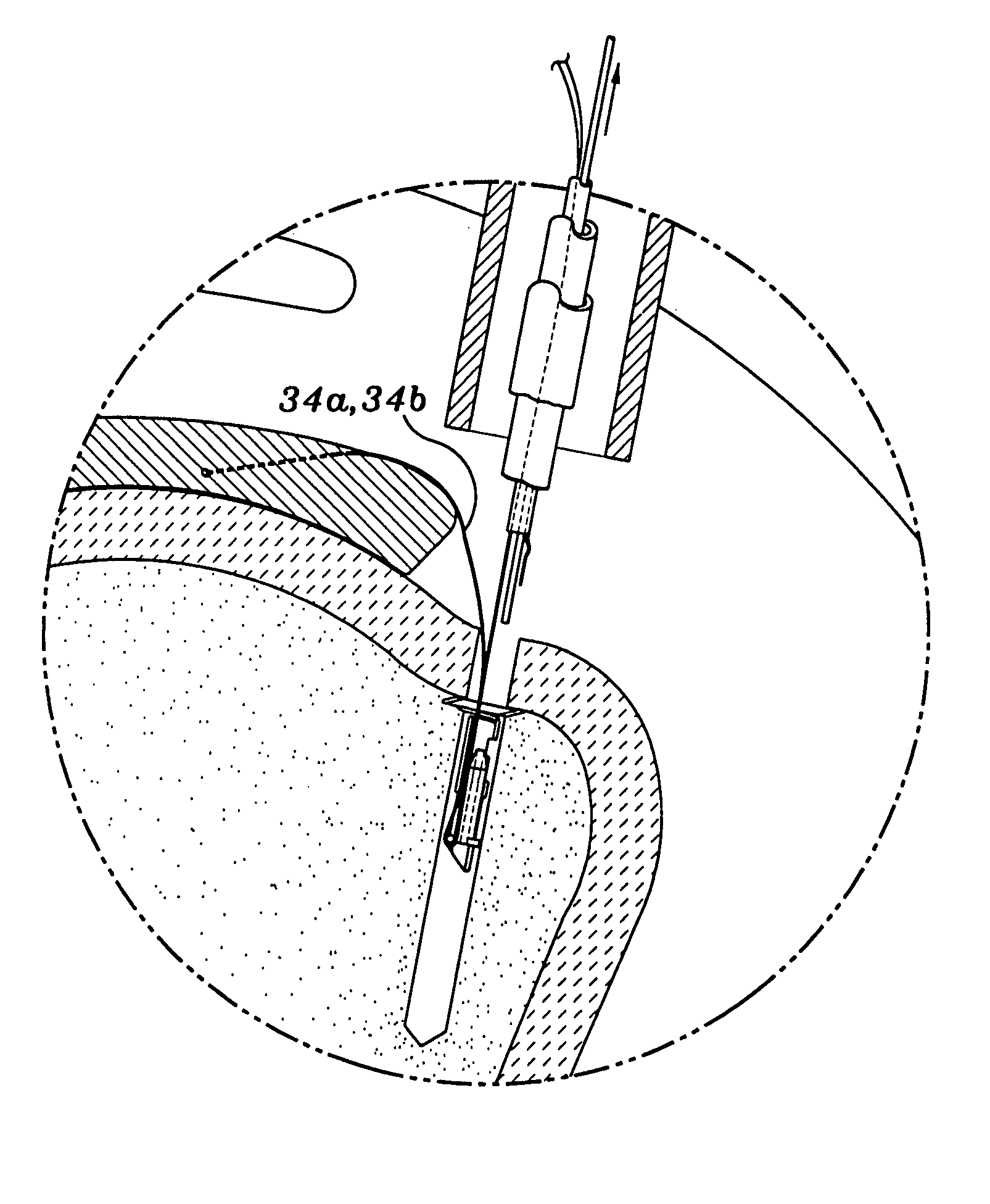 Knotless suture lock apparatus and method for securing tissue