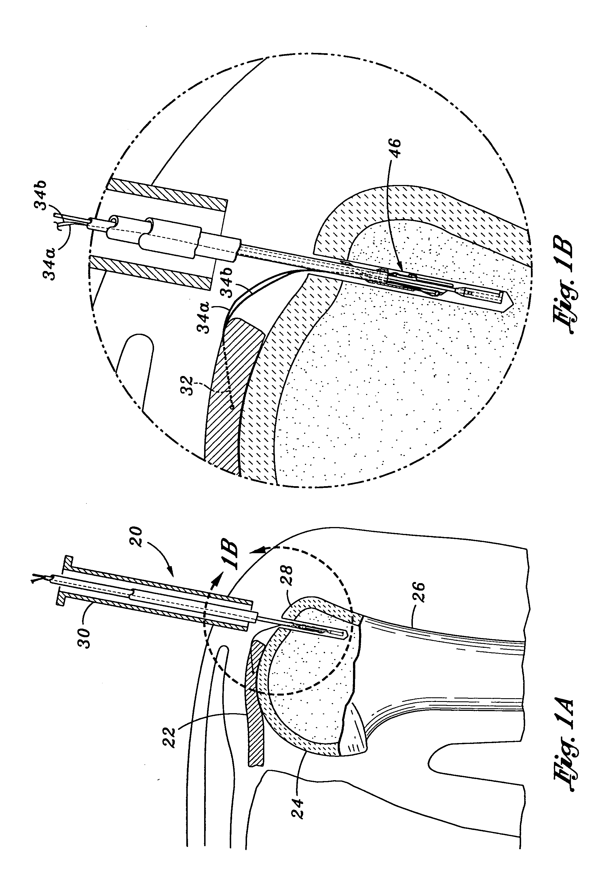 Knotless suture lock apparatus and method for securing tissue