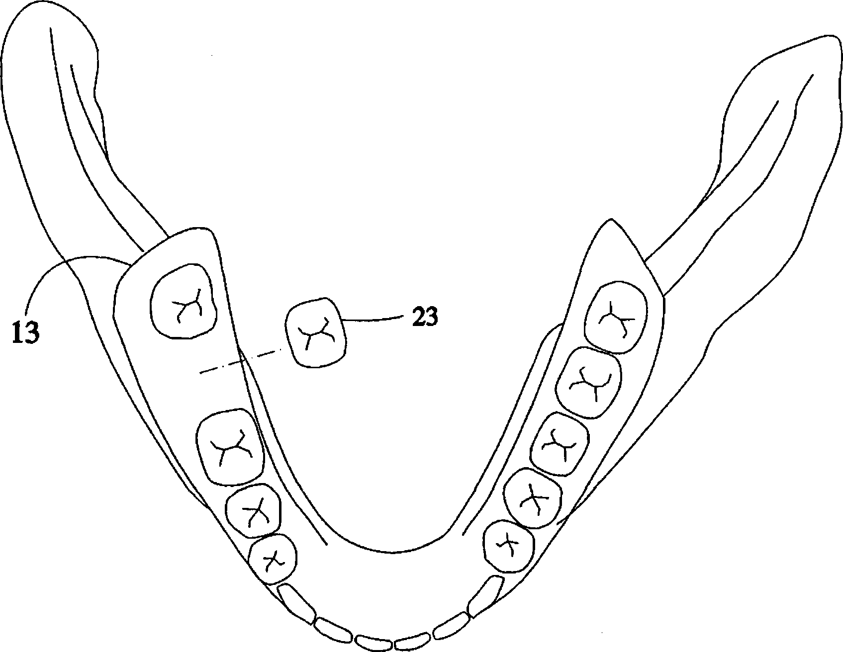 Digital supporting tooth design method by digital tooth implantation technology