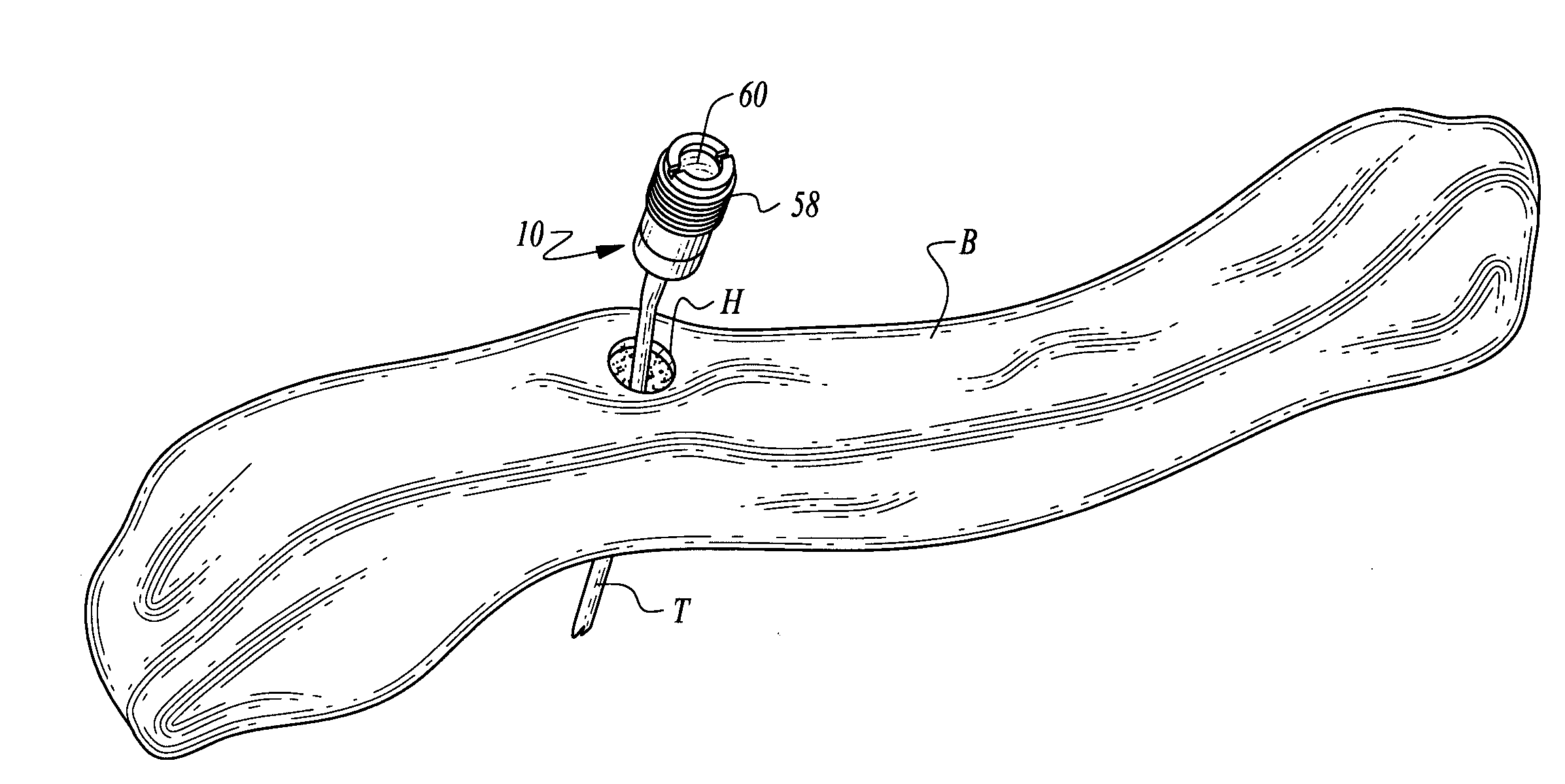 Bone supported vascular access port