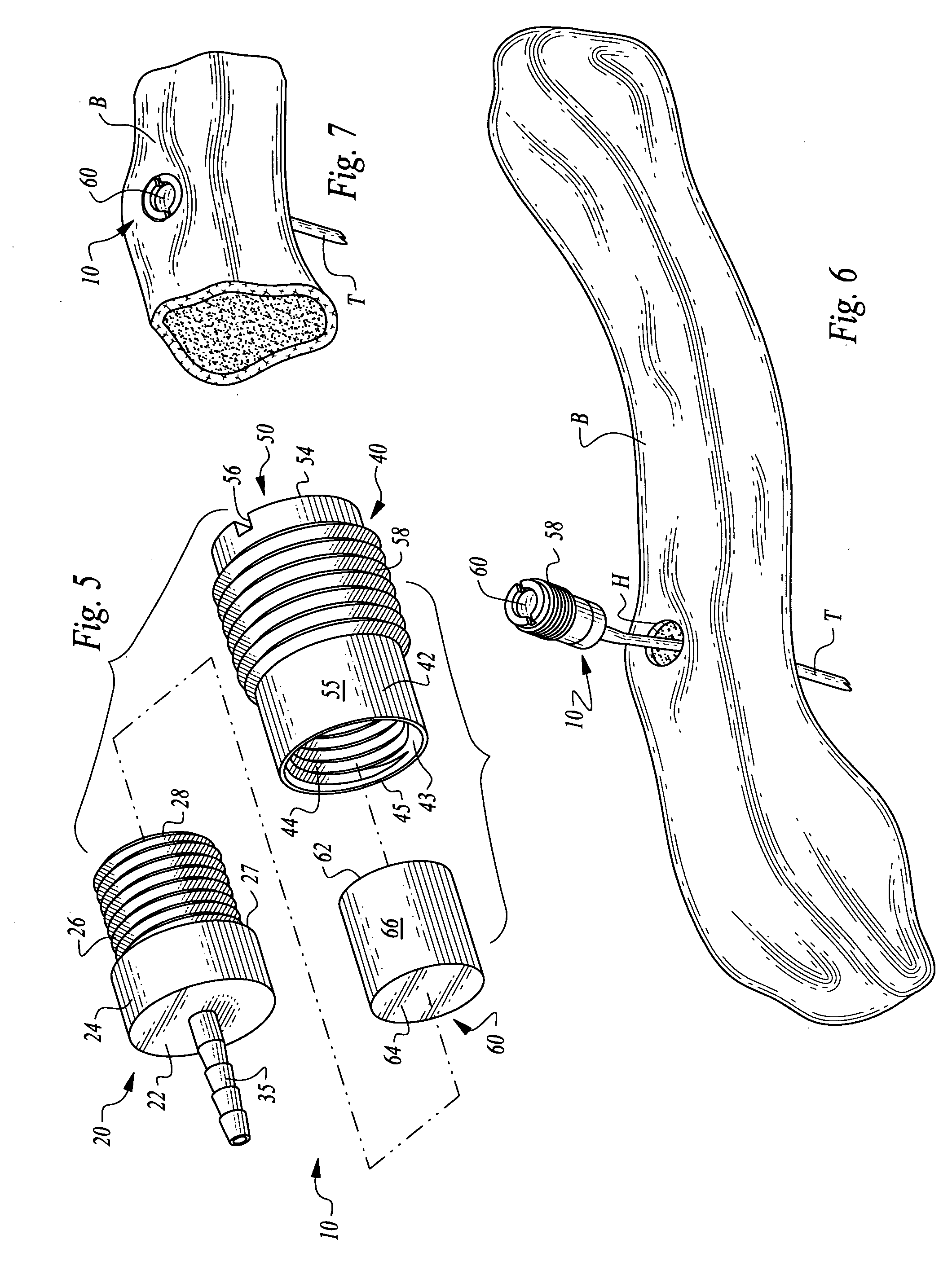 Bone supported vascular access port