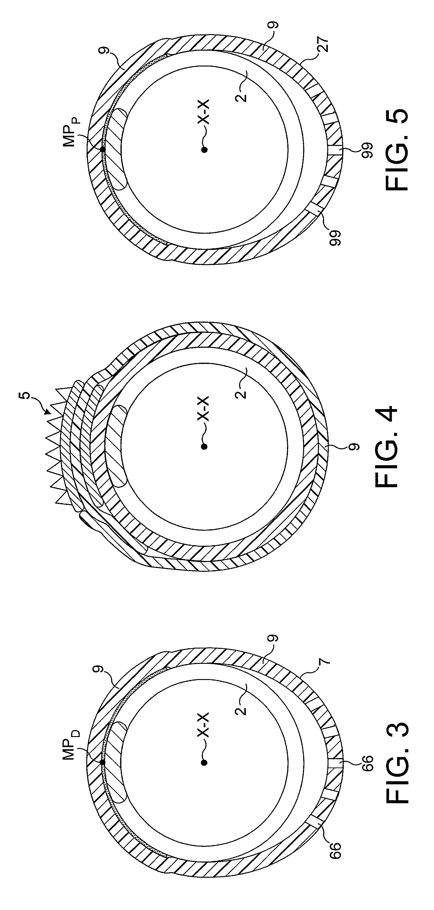 Rotational atherectomy device with fluid inflatable support elements and distal protection capability