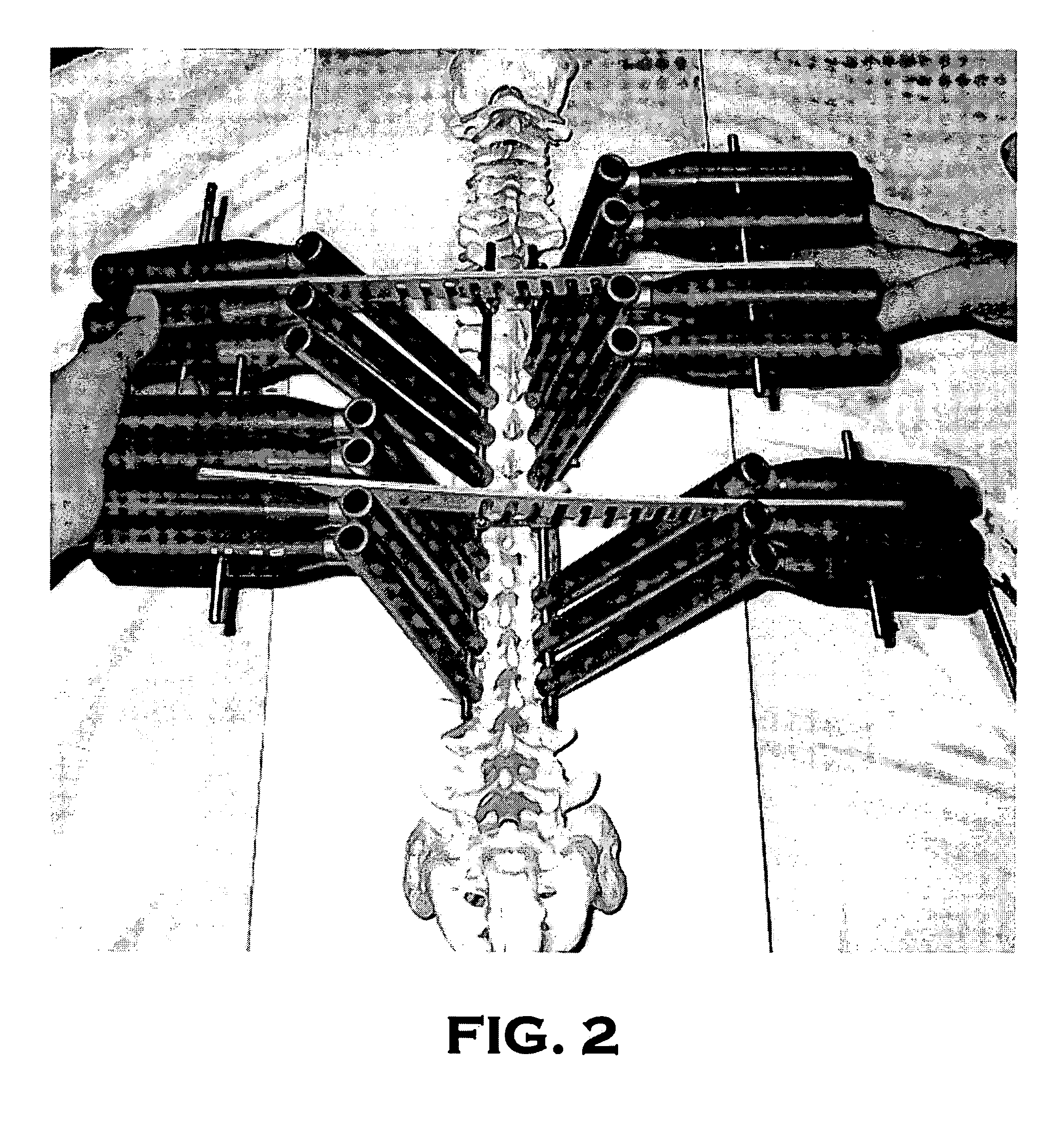 System and method for aligning vertebrae in the amelioration of aberrant spinal column deviation conditions