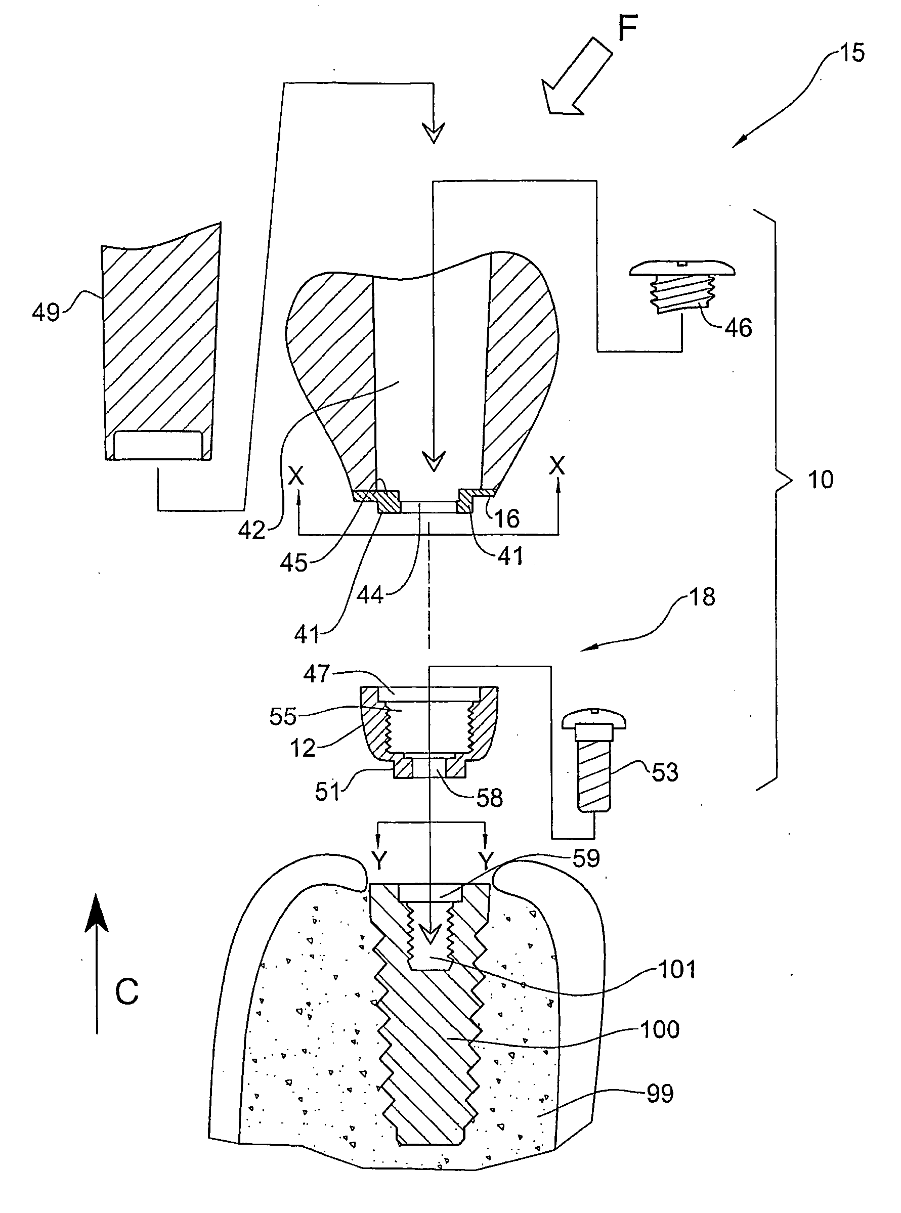 Temporary Dental Prosthesis