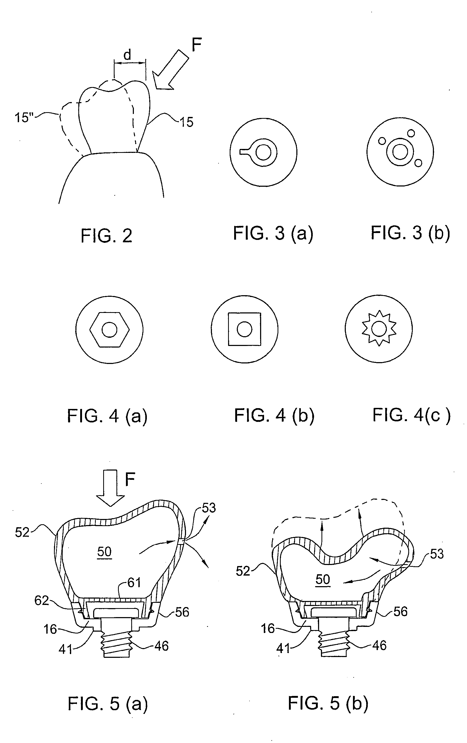 Temporary Dental Prosthesis